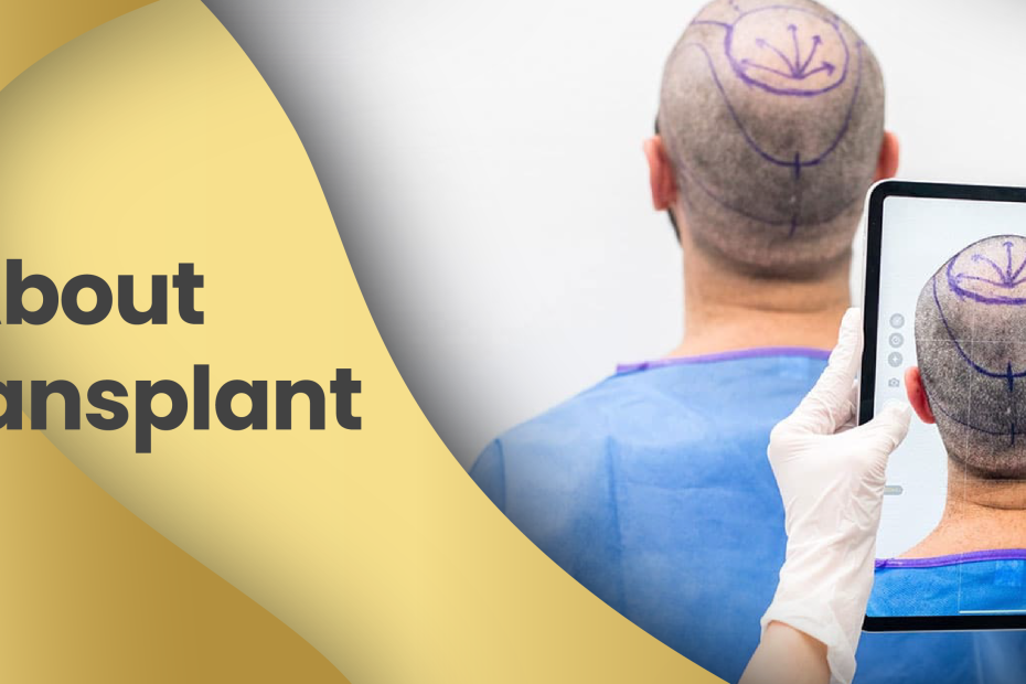 Facts About Hair Transplant in Turkey