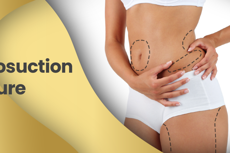 The Liposuction Procedure