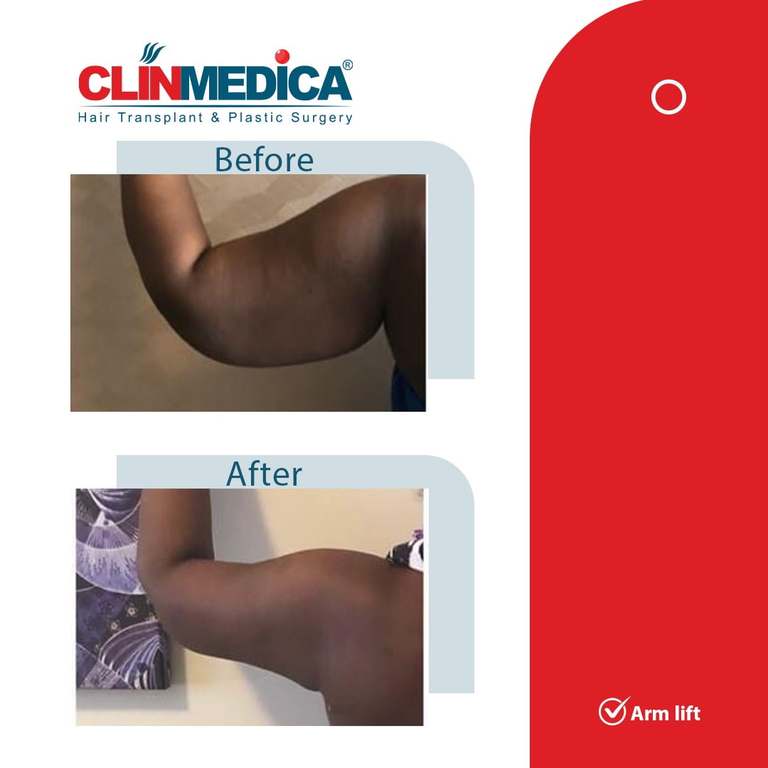 arm lift Turkey before and after clinmedica