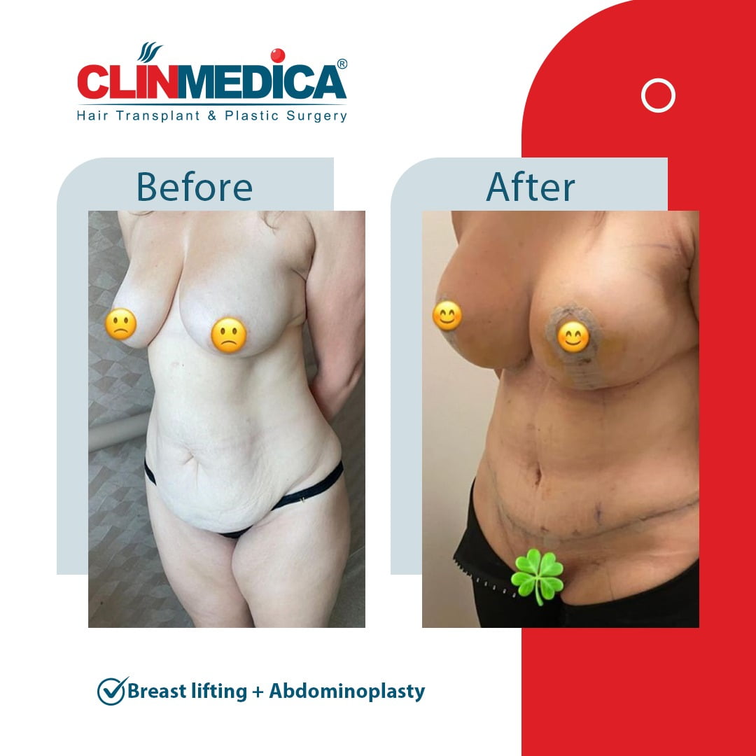 breast lift and Abdominoplasty Turkey before and after clinmedica