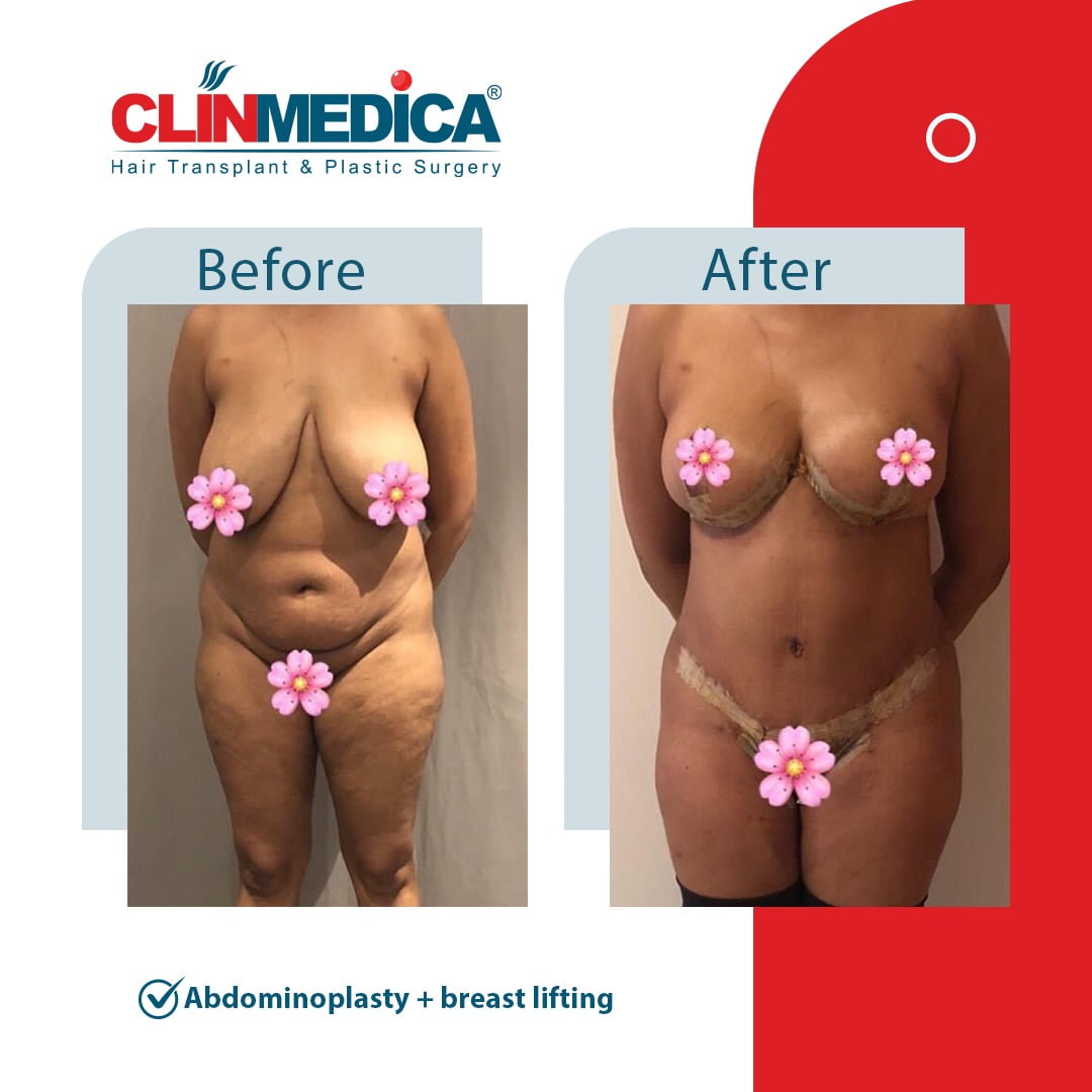 Abdominoplasty Tummy Tuck Turkey before and after clinmedica