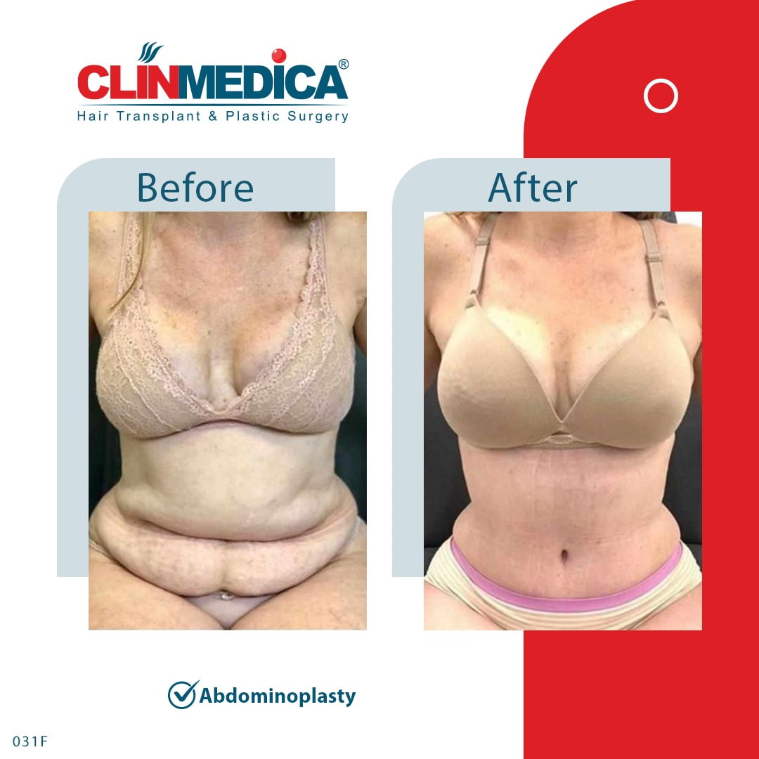 Abdominoplasty Tummy Tuck Turkey before and after clinmedica