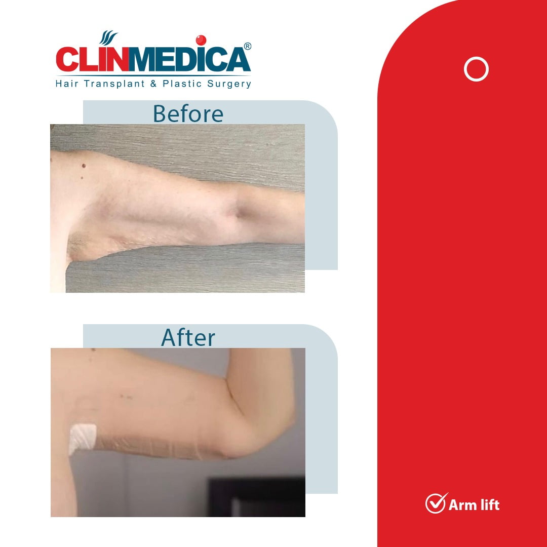 Arm Lift Surgery Turkey before and after clinmedica