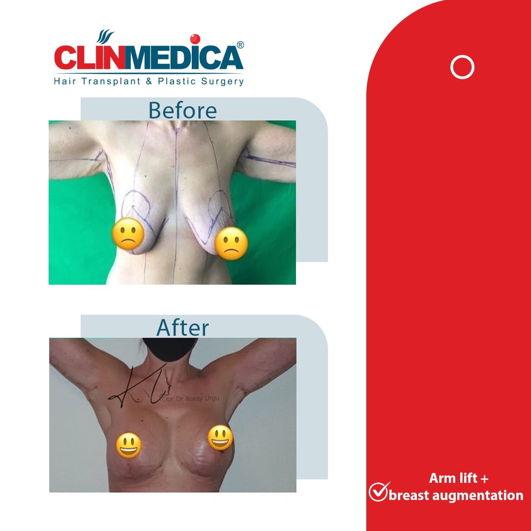 Arm Lift Surgery Turkey before and after clinmedica