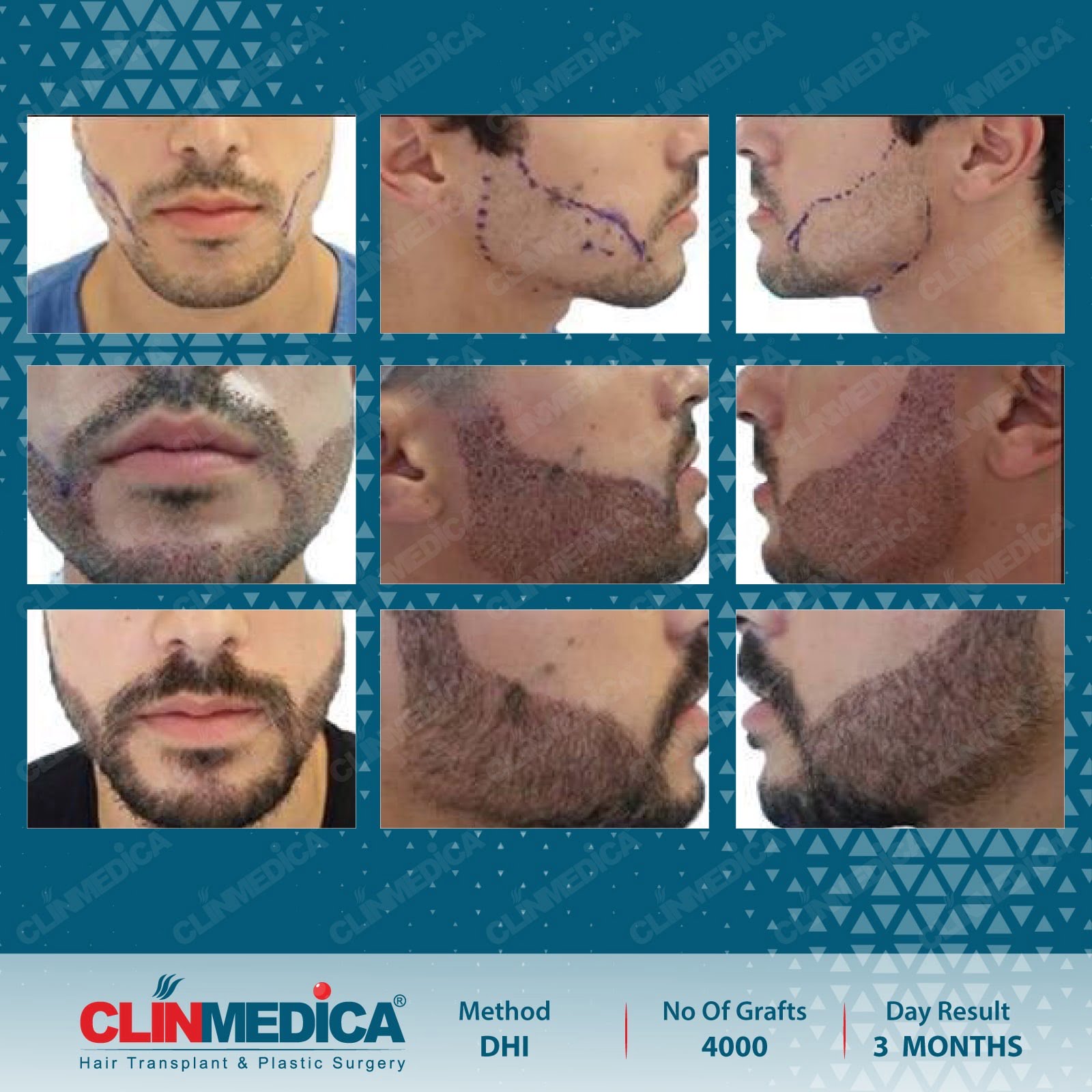 Trapianto di barba in Turchia | Risultati prima e dopo P1 | Recensioni dei pazienti | ClinMedica
