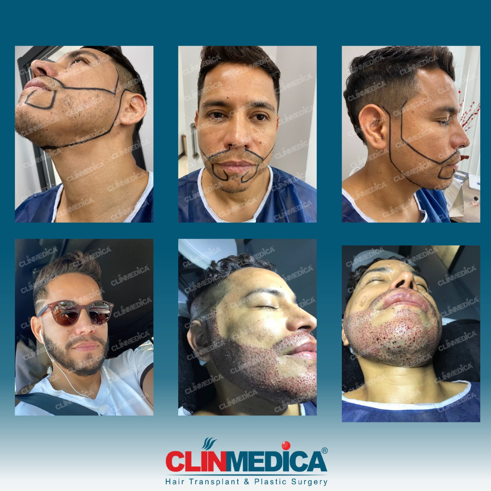 Trapianto di barba in Turchia | Risultati prima e dopo P2 | Recensioni dei pazienti | ClinMedica