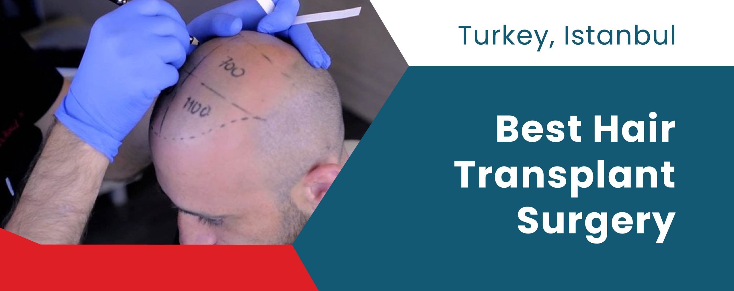 Best Hair Transplant Surgery In Turkey | ClinMedica
