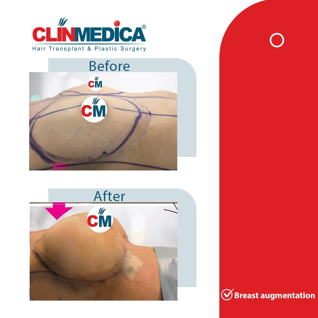 Breast Augmentation Turkey before and after clinmedica