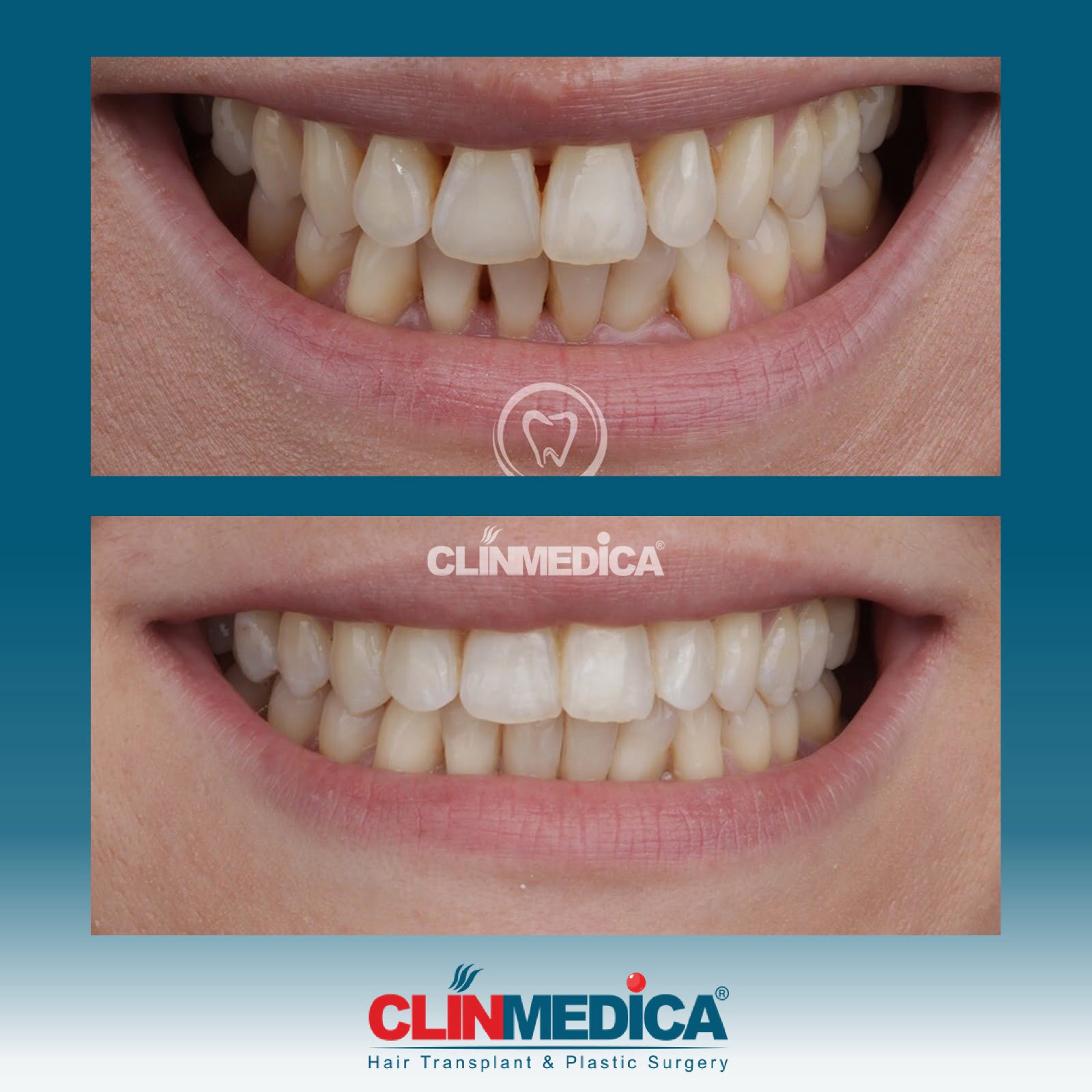 Dental Cosmetics In Turkey Before After Clinmedica