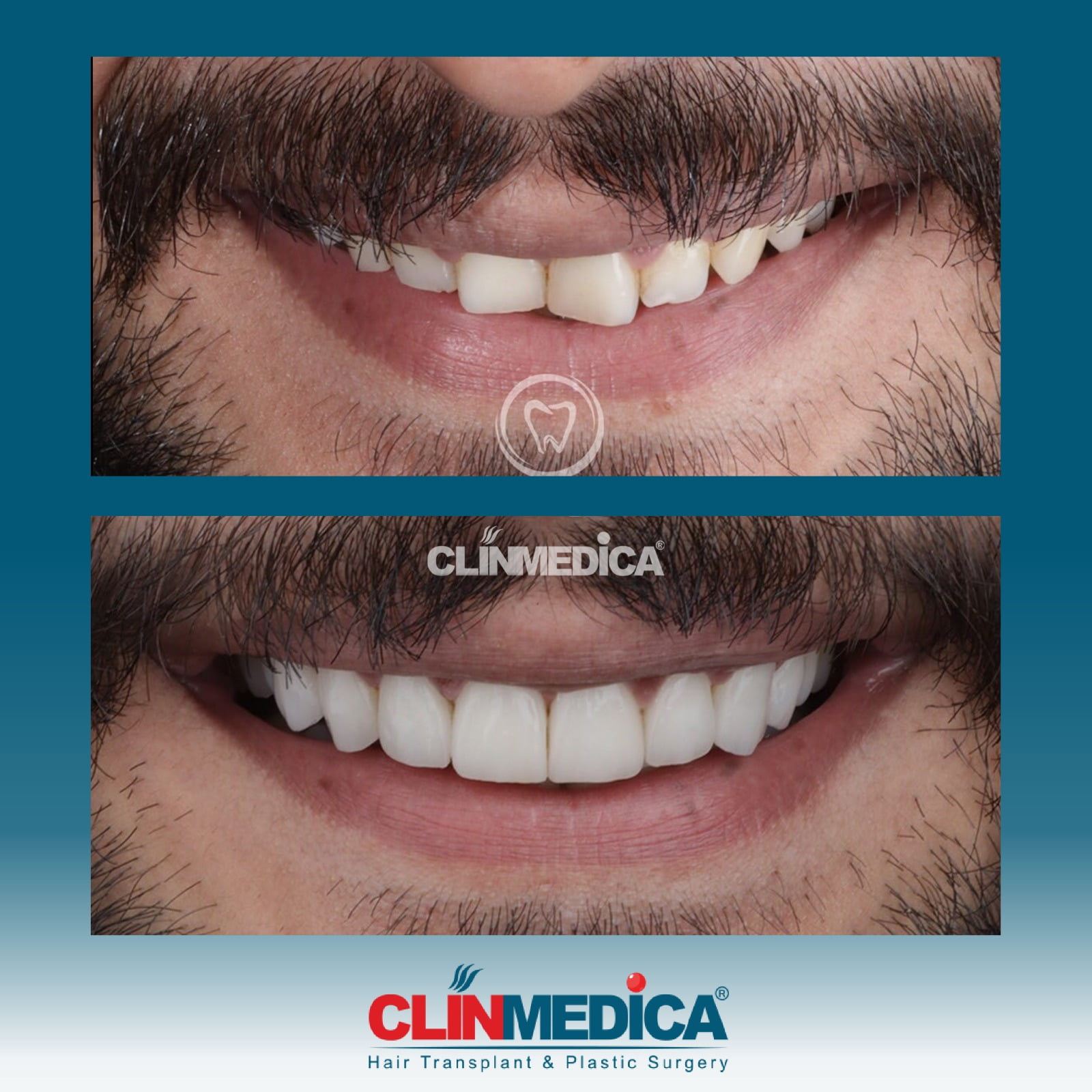 Dental Cosmetics in Turkey | ClinMedica | Hollywood Smile