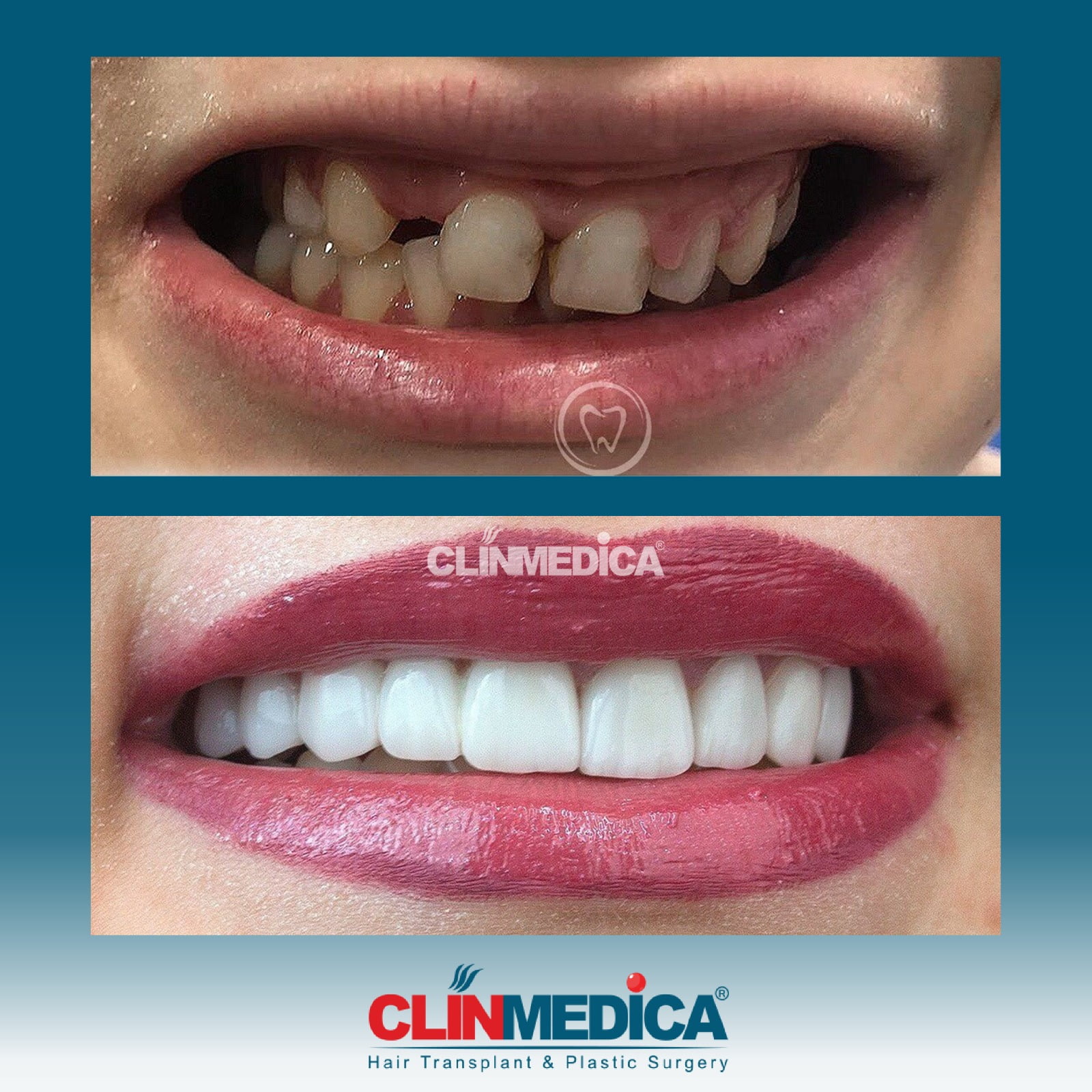 Dental Cosmetics In Turkey Before After Clinmedica