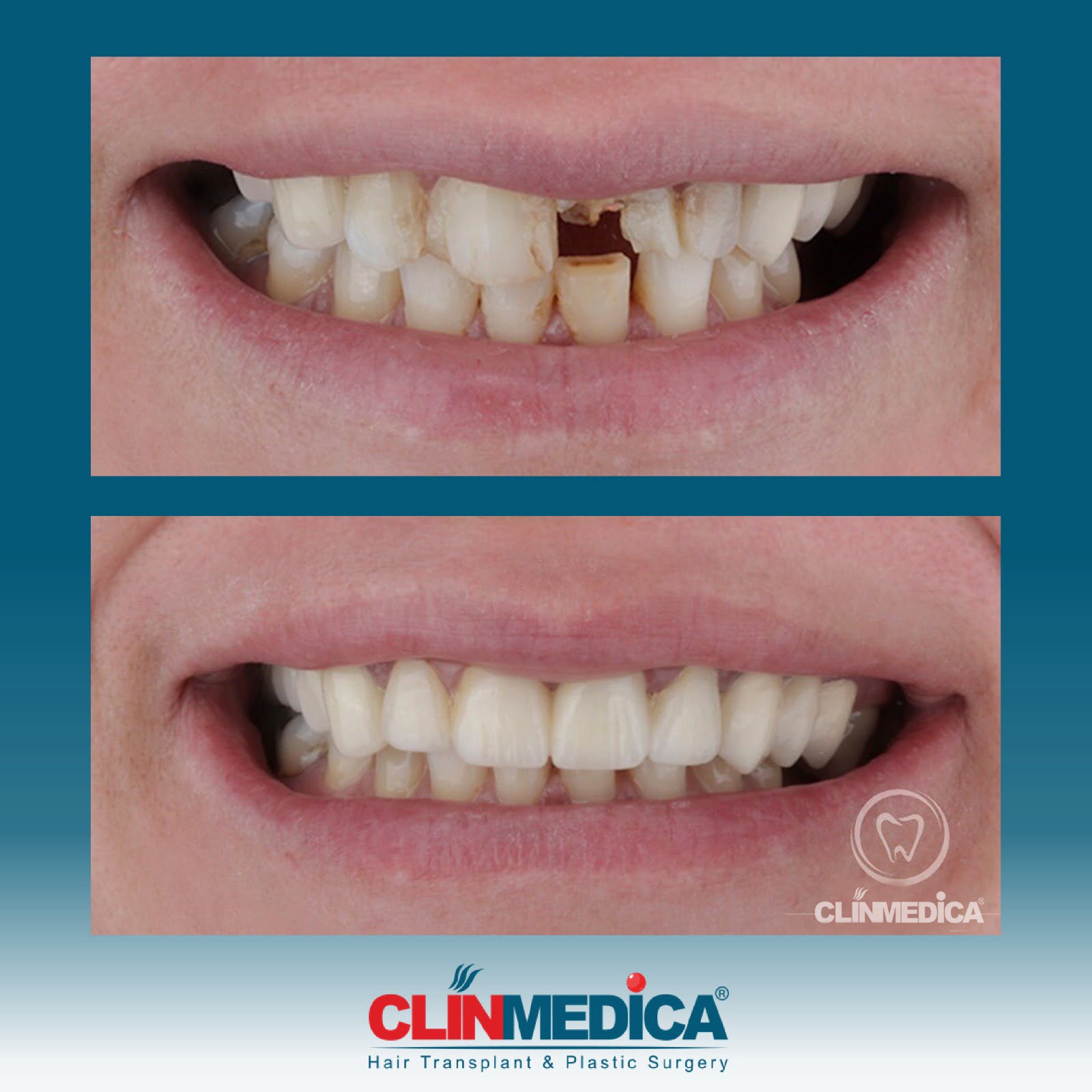 Hollywood smile Turkey Before After Clinmedica