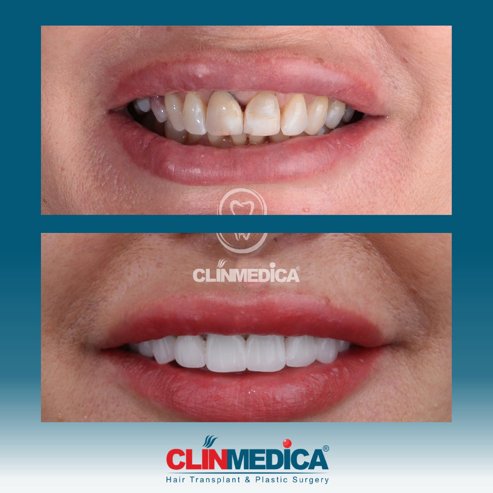 Hollywood smile Turkey Before After Clinmedica