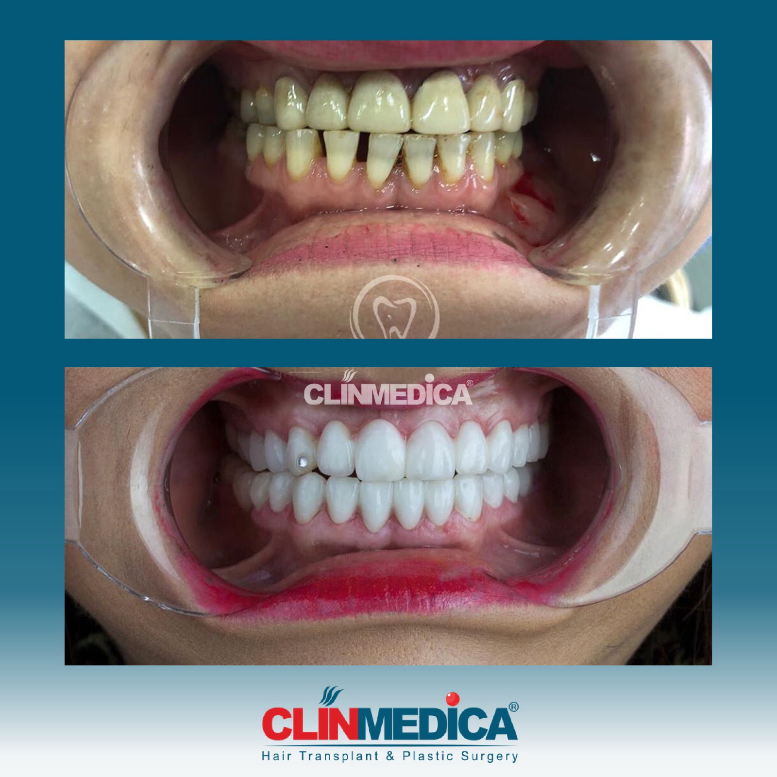 Zahnkosmetik in der Türkei | Zahnimplantate P1 | ClinMedica