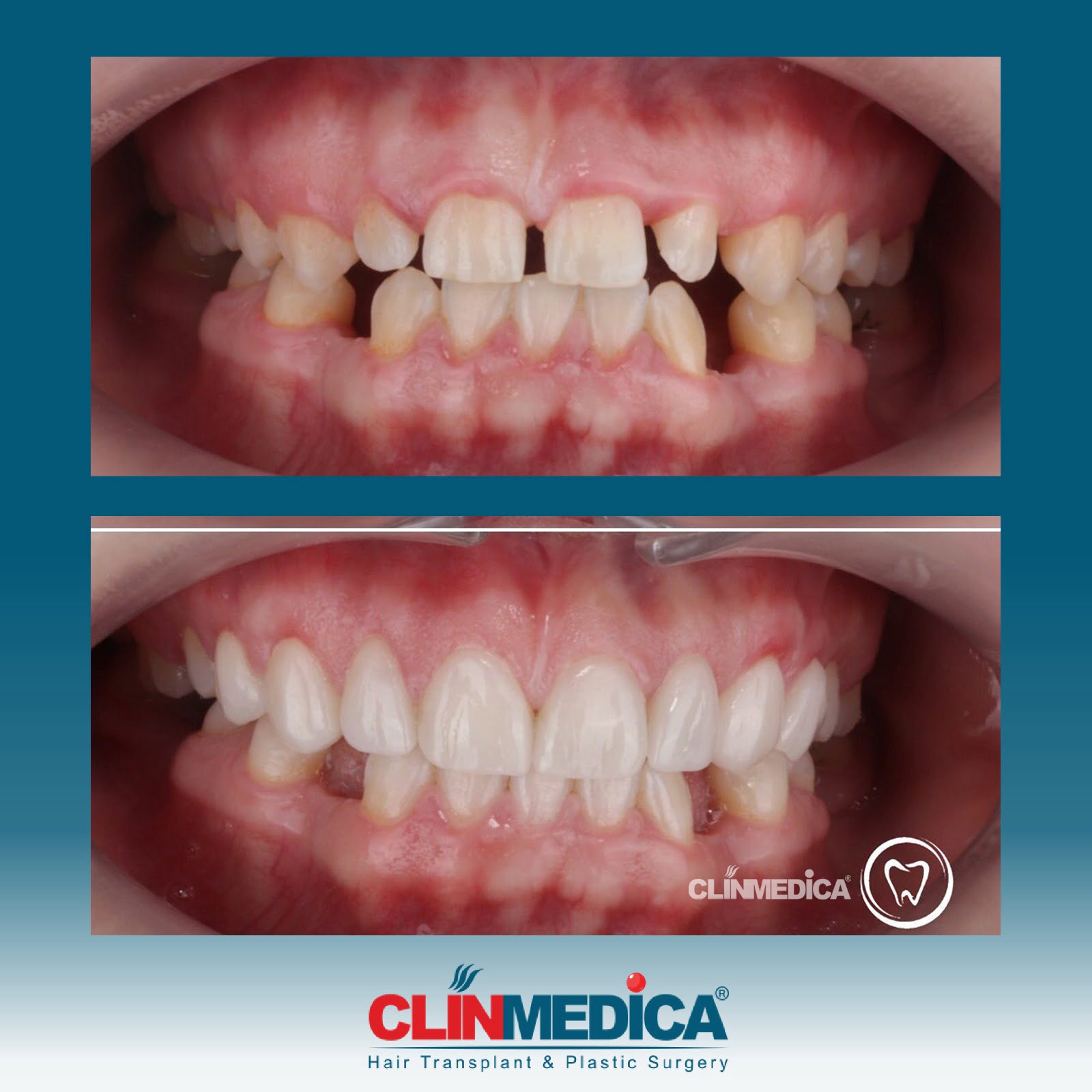 dental cosmetics before and after results in Turkey