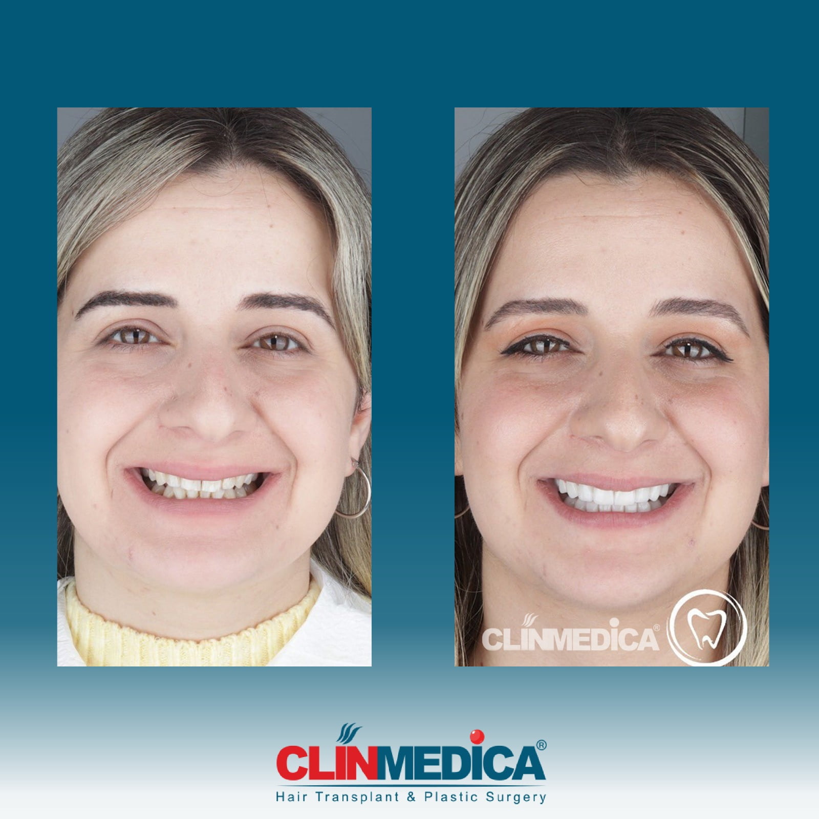 Cosmétiques dentaires en Turquie Résultats avant et après P2 | ClinMedica