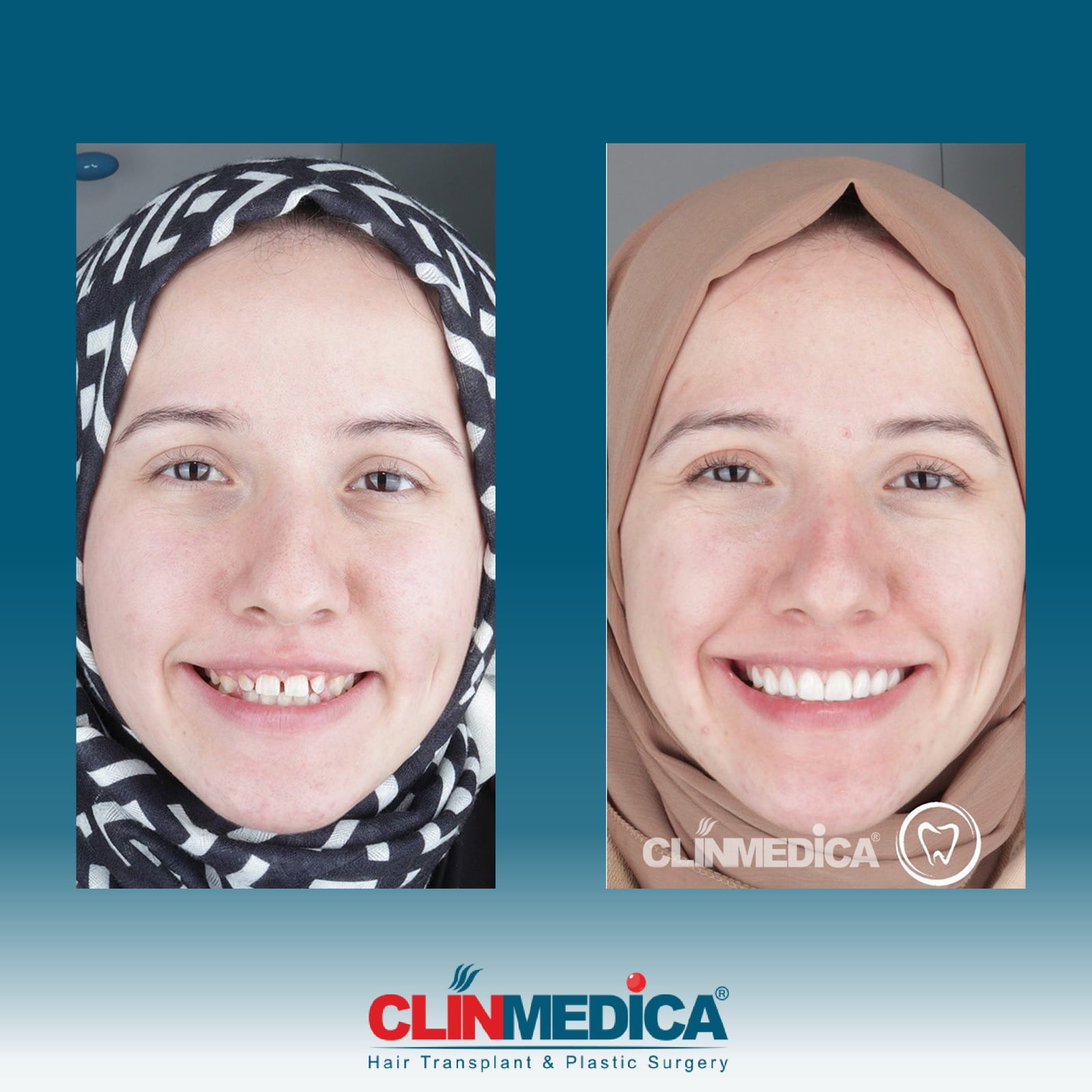 Zahnkosmetik vor und nach den Ergebnissen in der Türkei