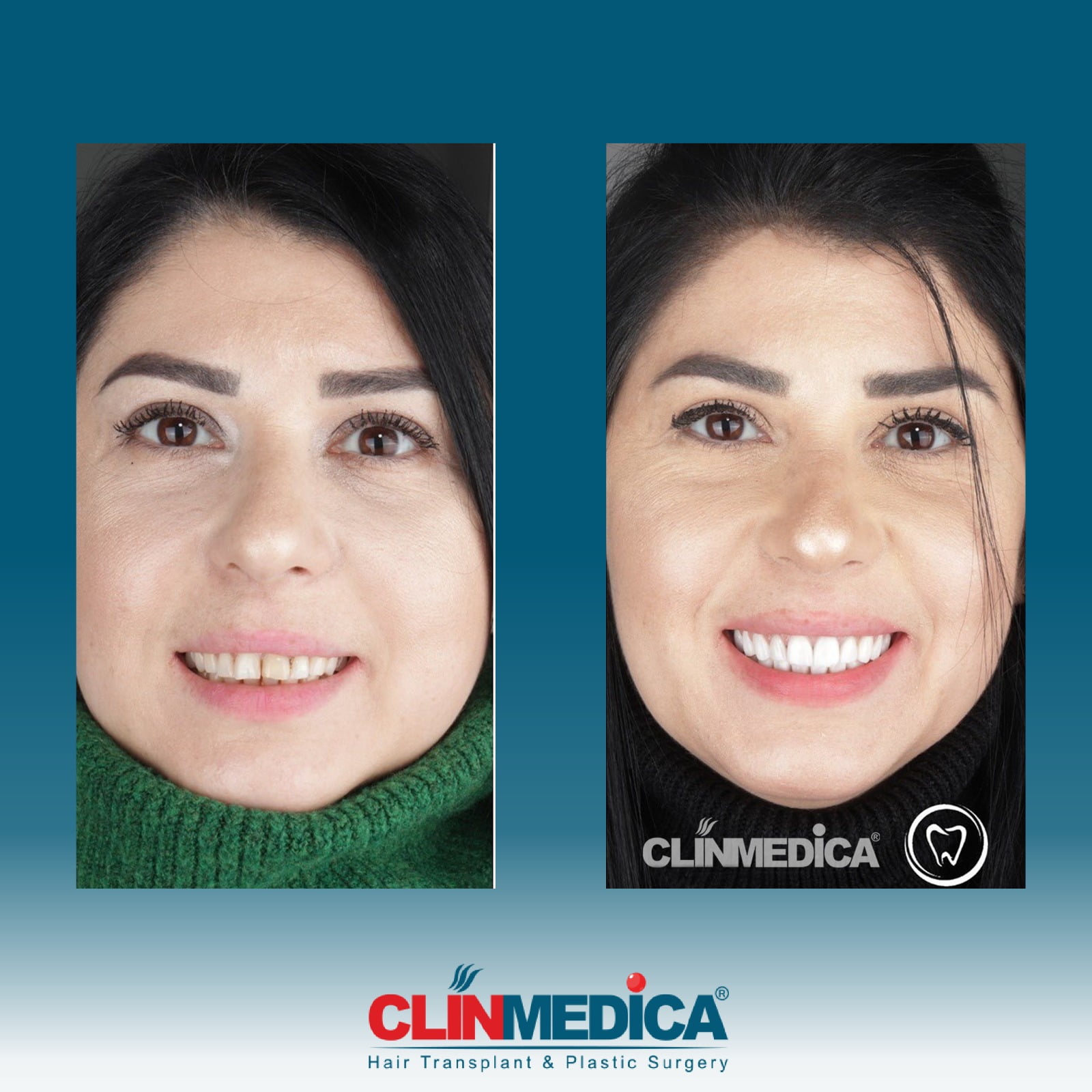 dental cosmetics before and after results in Turkey