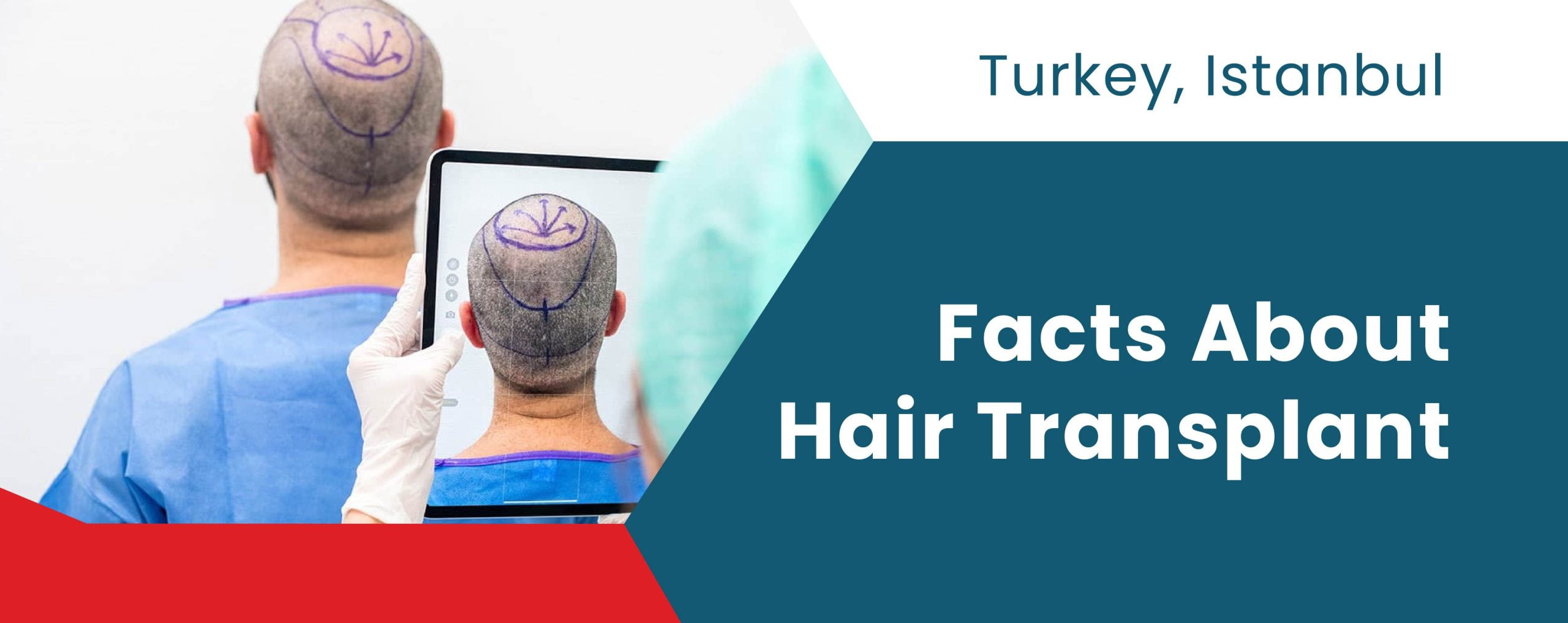 Fakten über Haartransplantation