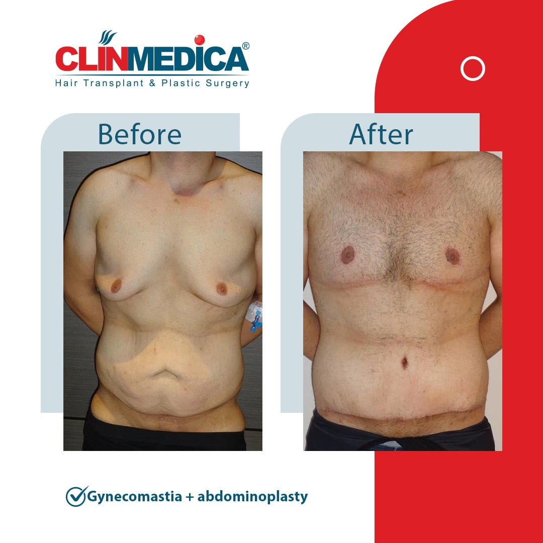 Gynecomastia and abdominoplasty Turkey before and after clinmedica