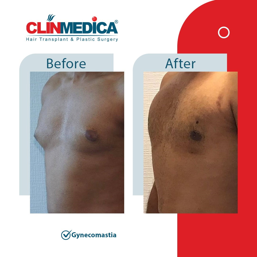 Gynecomastia Turkey before and after clinmedica