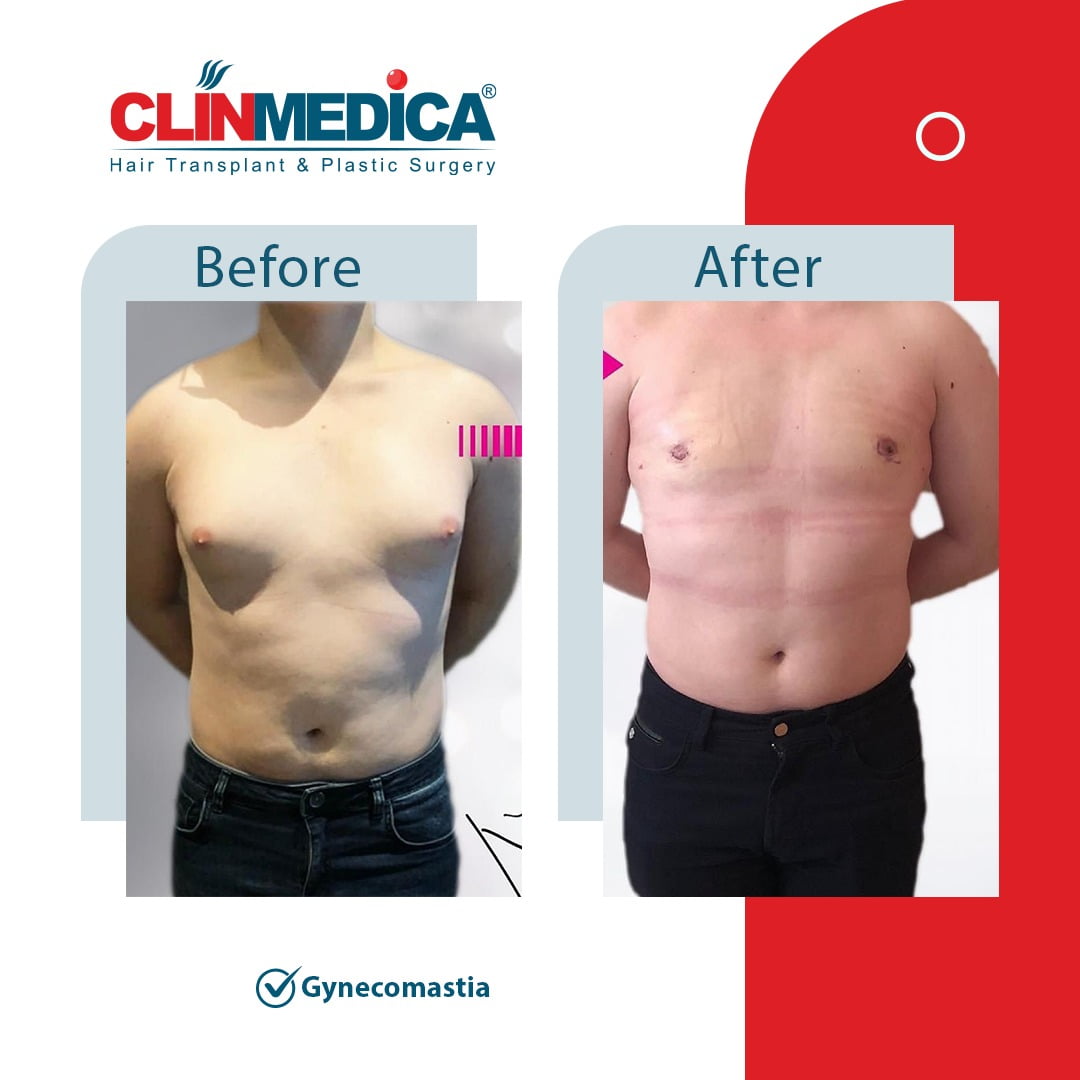 Gynecomastia Turkey before and after clinmedica