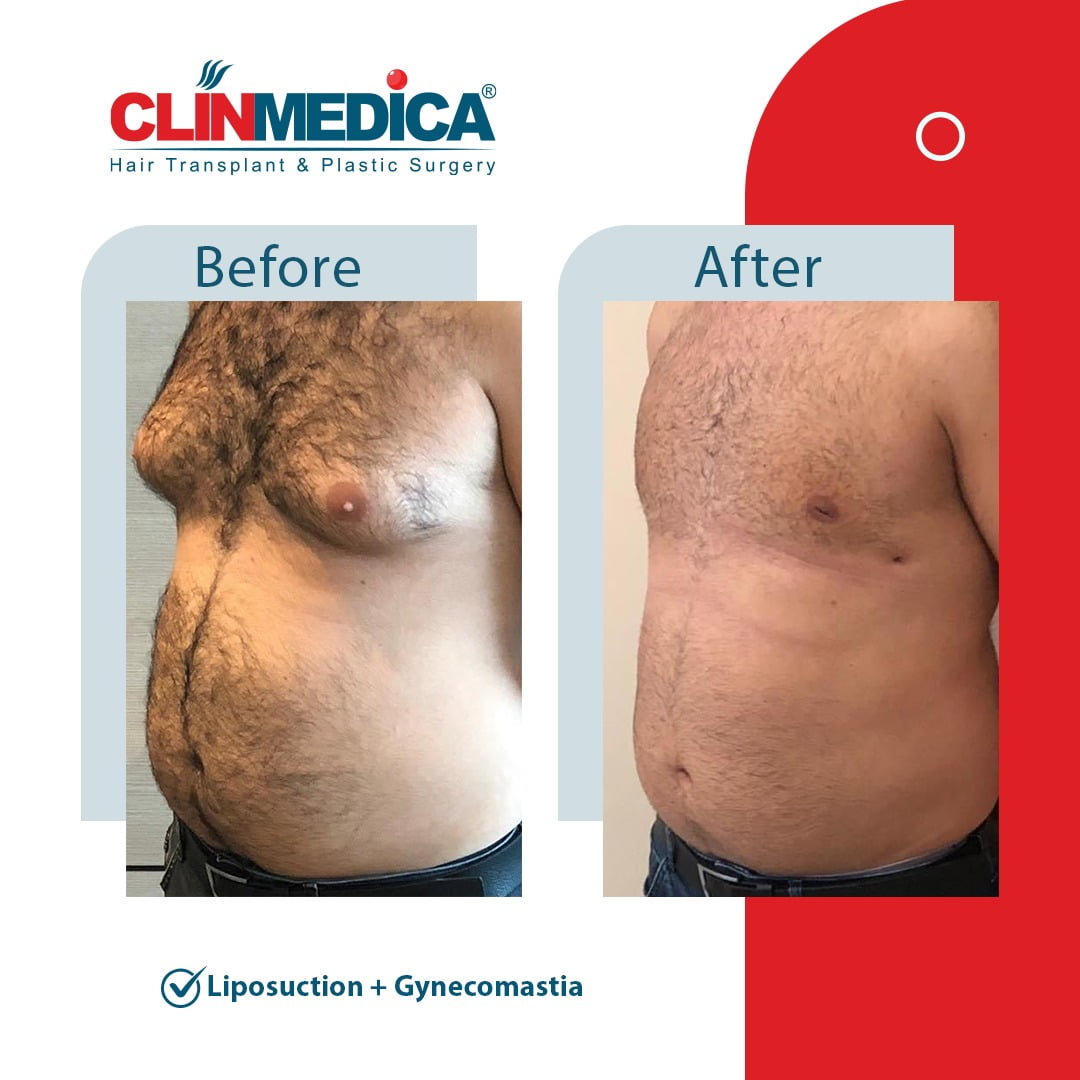 liposuction Turkey before and after clinmedica