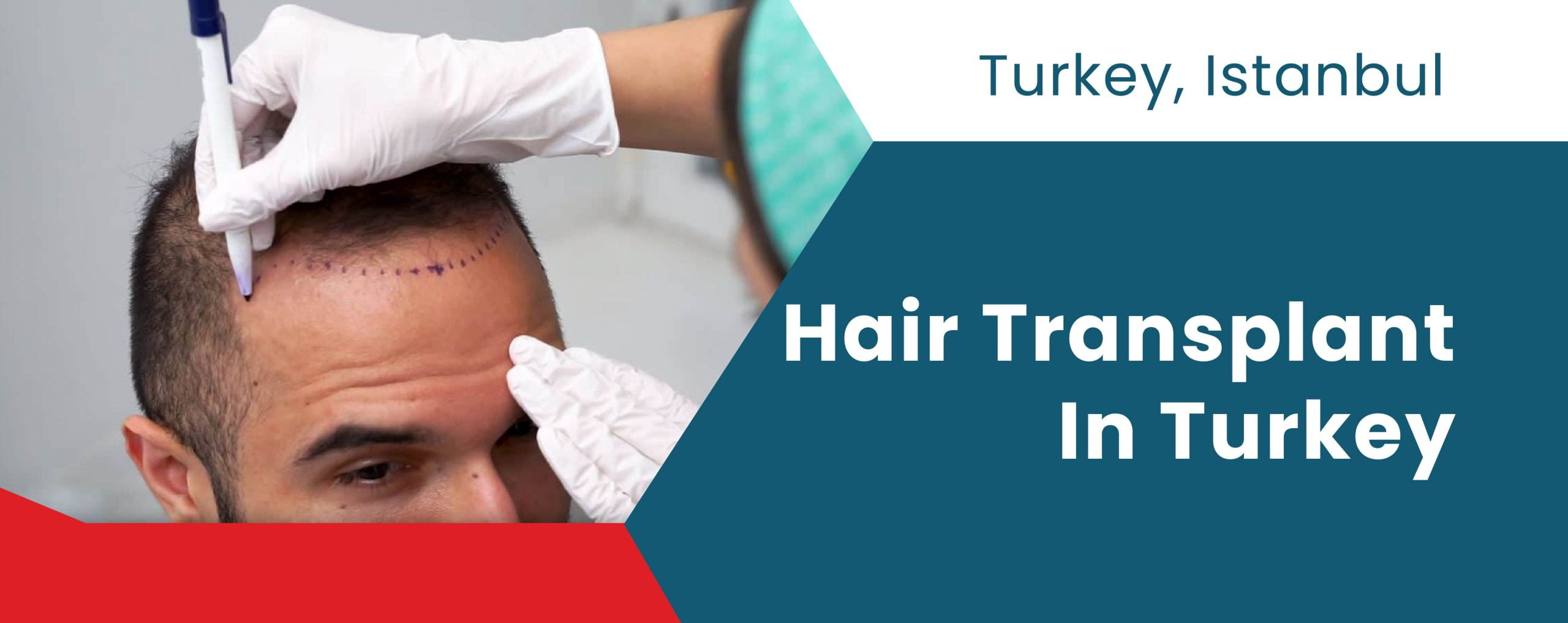 Hair Transplant In Turkey