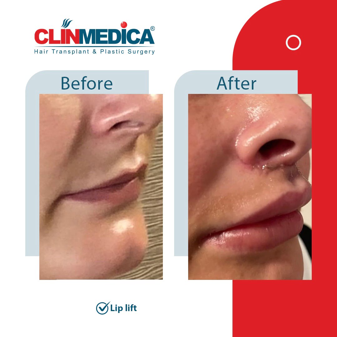 lip lift Turkey before and after clinmedica