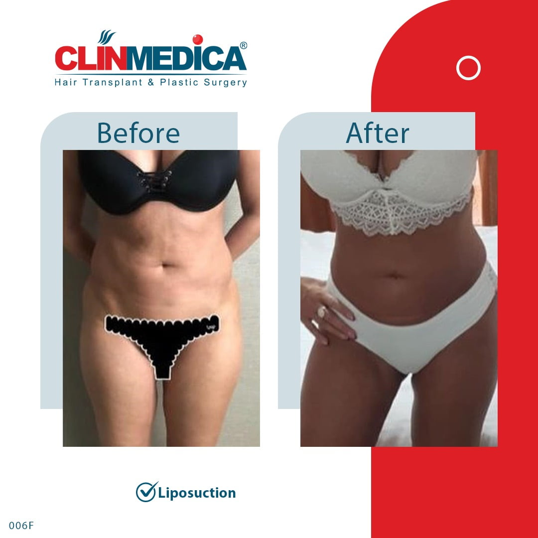 Liposuction Turkey before and after clinmedica
