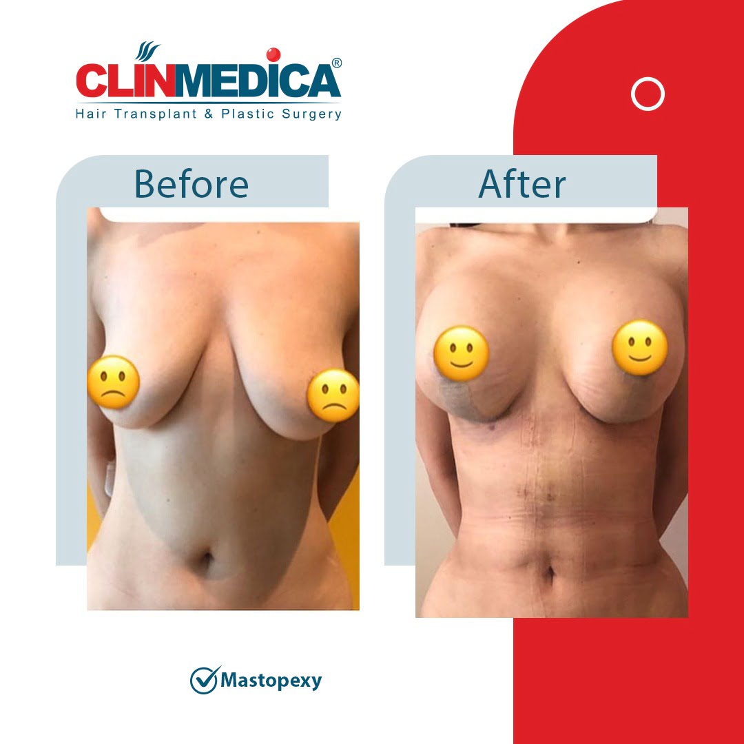 mastopexy Turkey before and after clinmedica