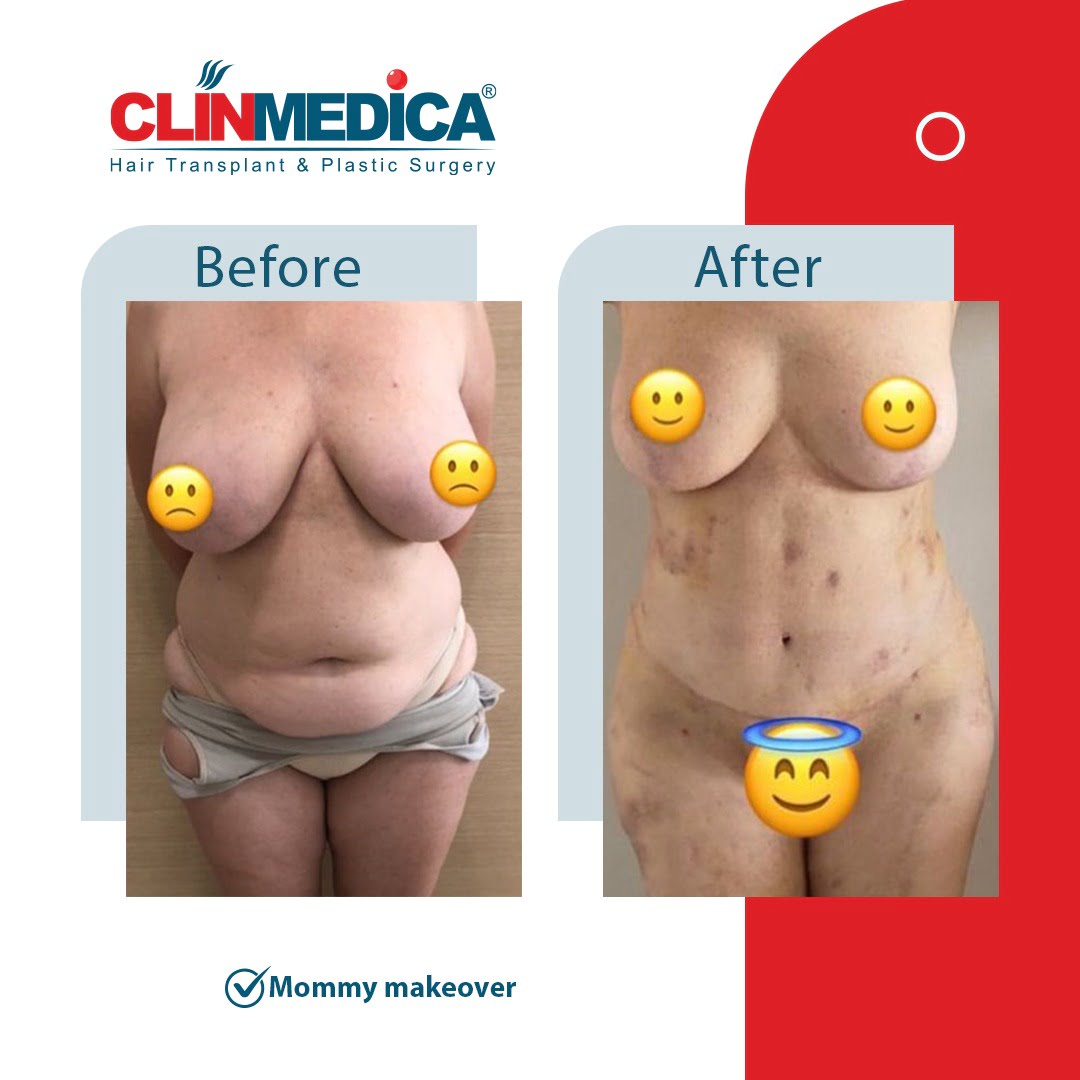 mommy makeover Turkey before and after clinmedica