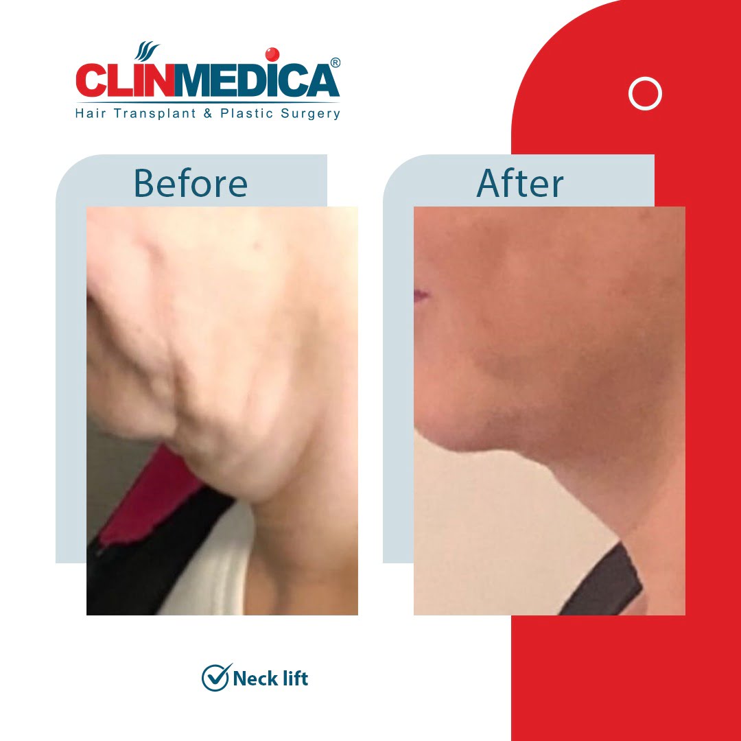 neck lift Turkey before and after clinmedica