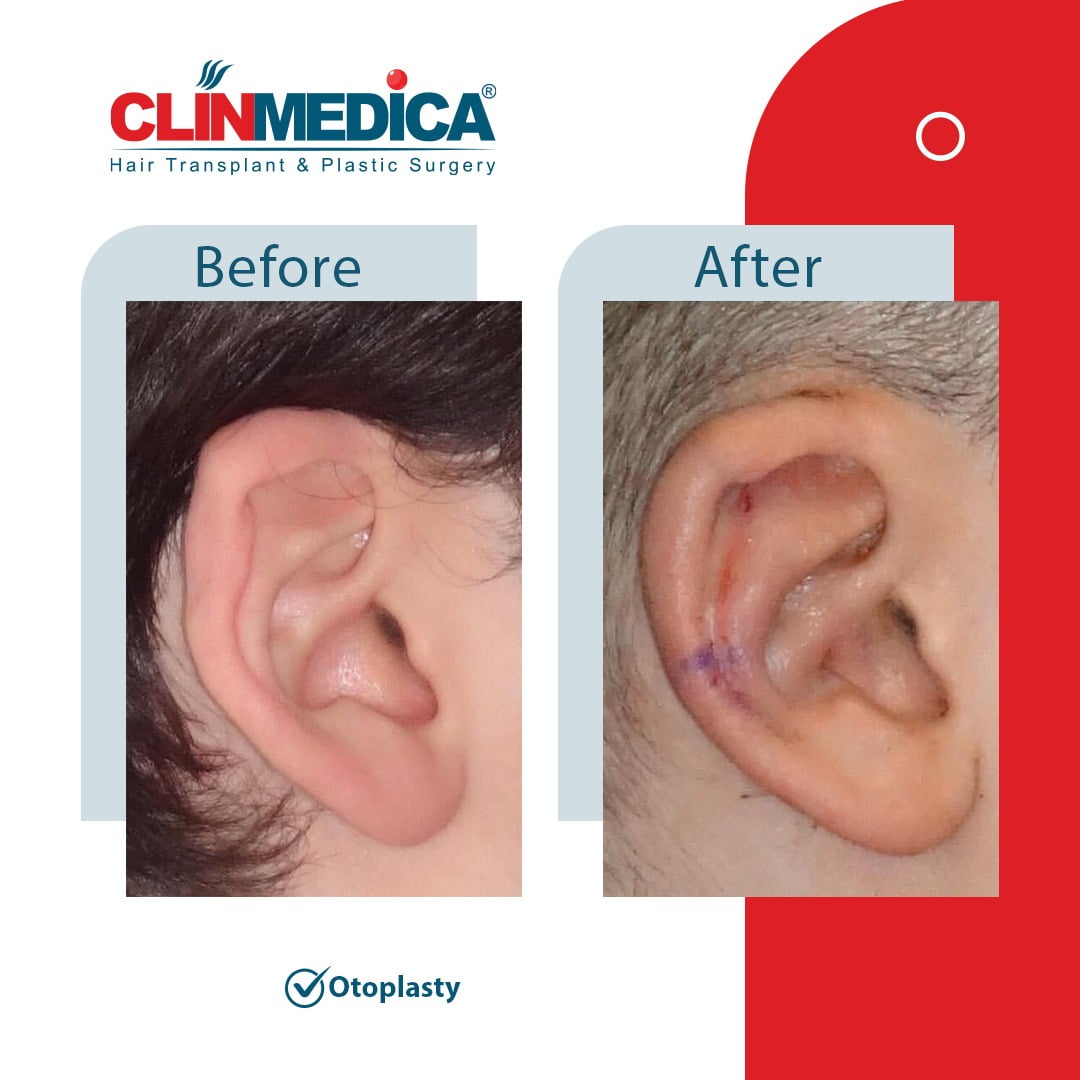Otoplasty Turkey before and after clinmedica