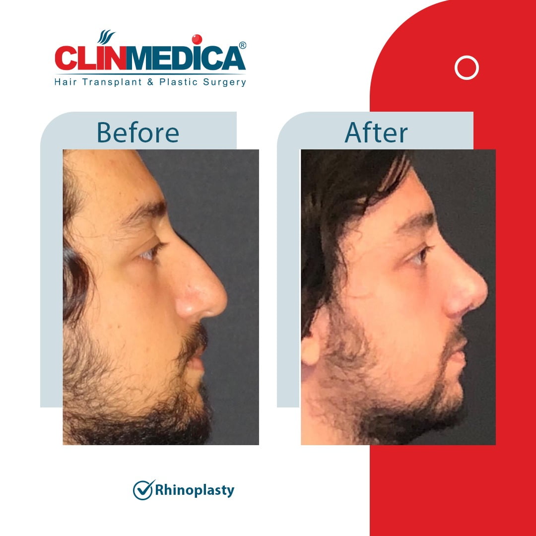 Rhinoplasty Turkey before and after clinmedica