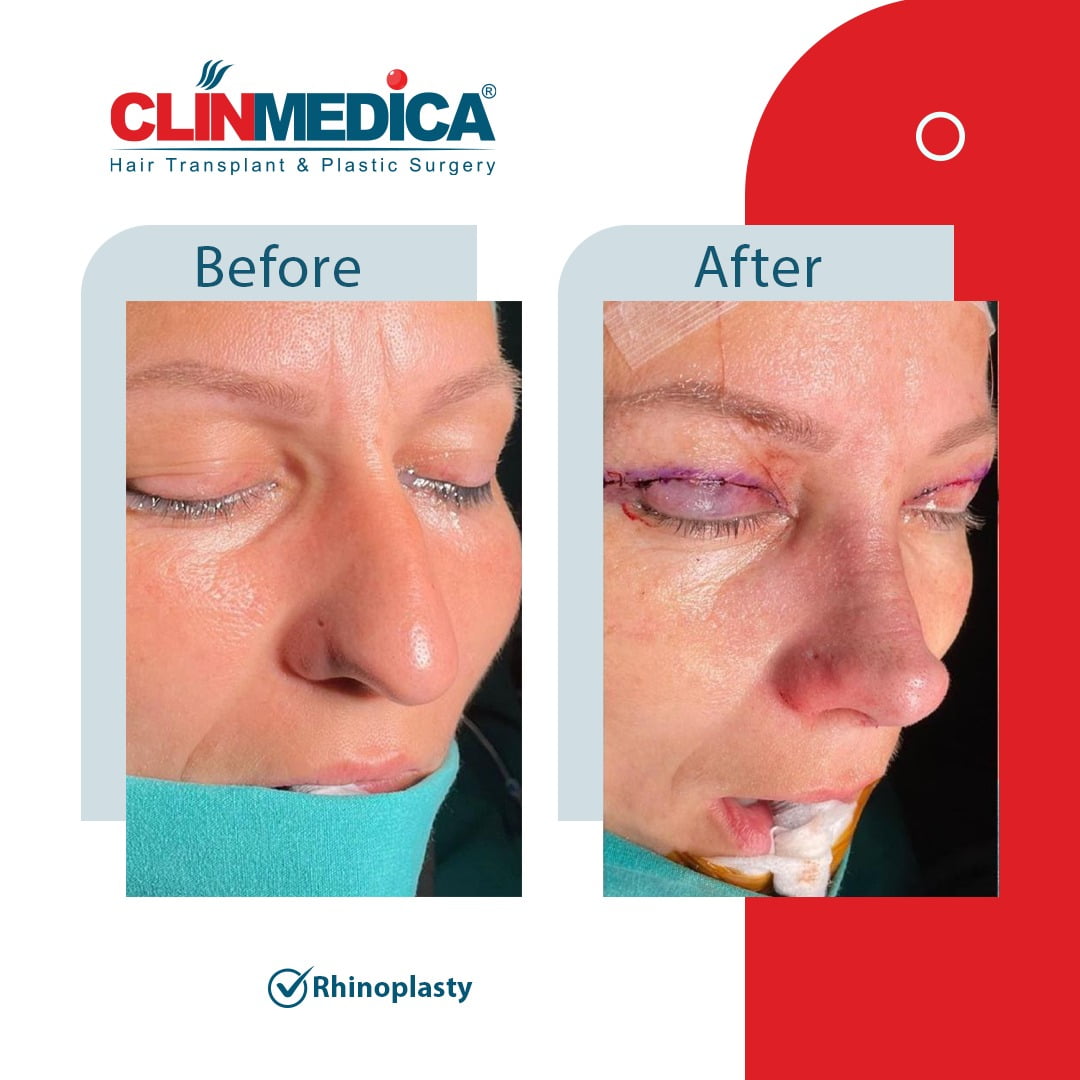 Rhinoplasty Turkey before and after clinmedica