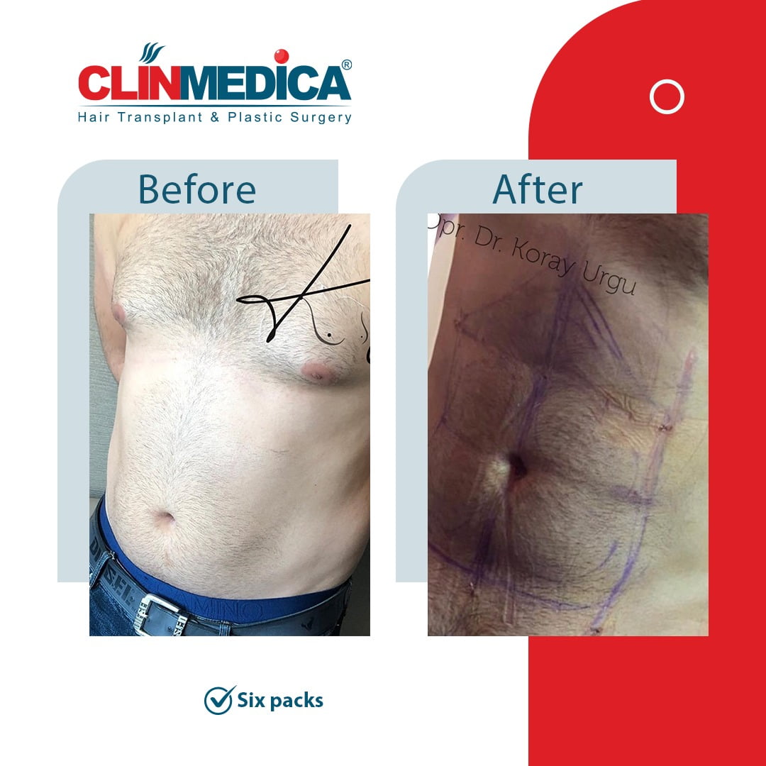 sick pack Turkey before and after clinmedica