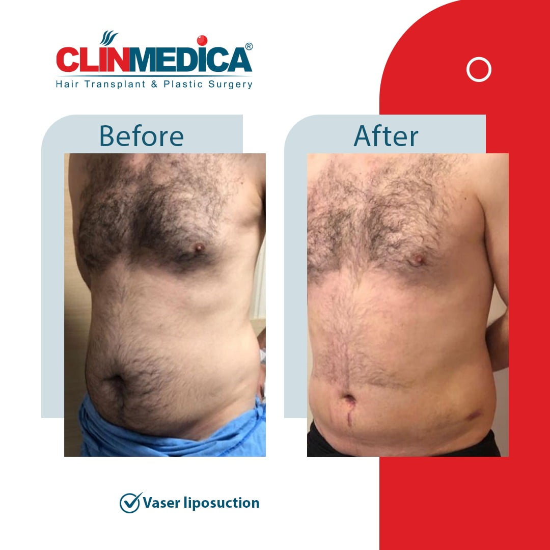 Vaser Liposuction Turkey before and after clinmedica