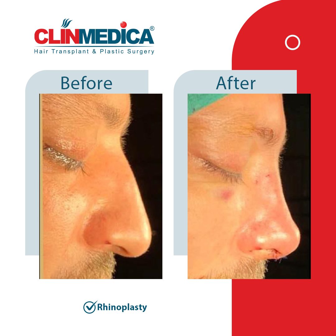Rhinoplasty in Turkey Before and After