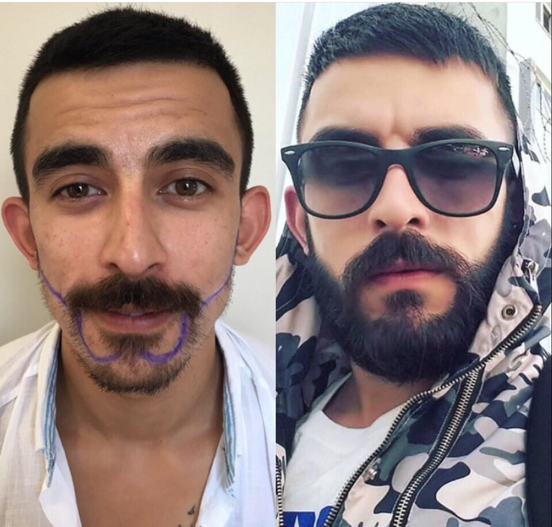 Beard Transplant In Turkey
