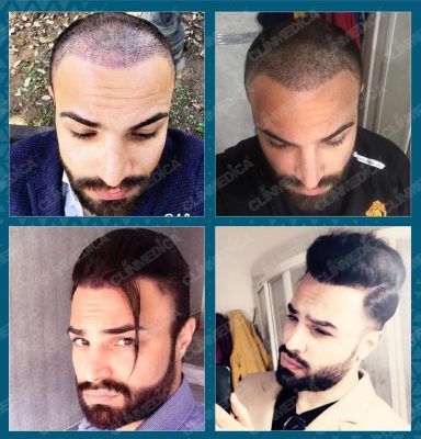 hair transplant before after in Turkey