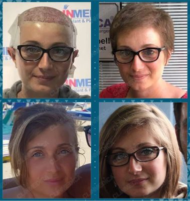 hair transplant before after in Turkey Women