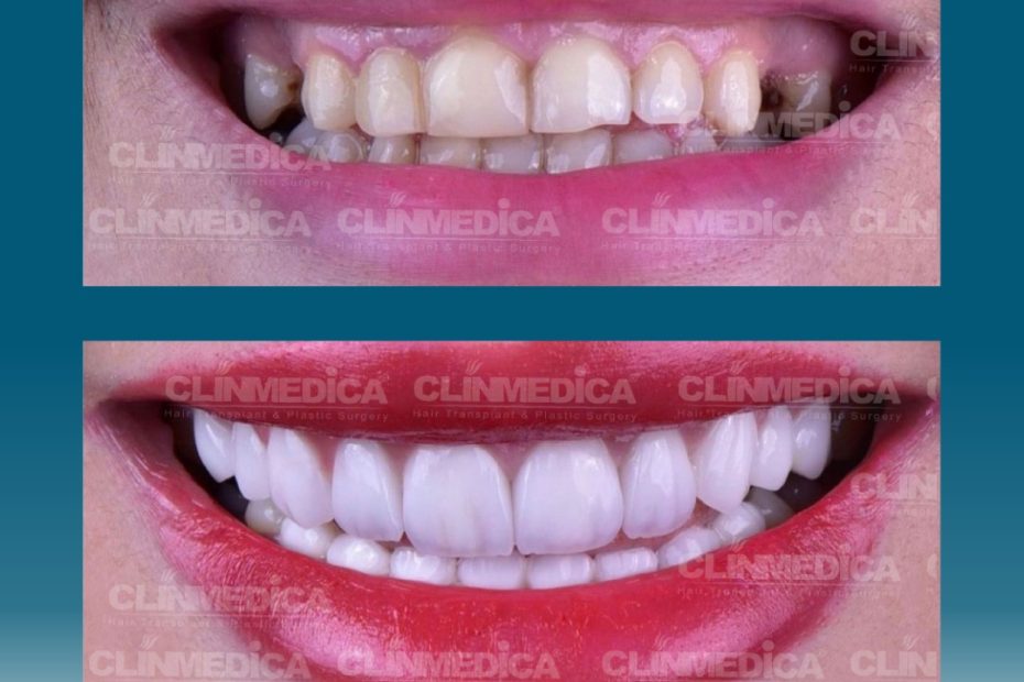 Dental Cosmetics in Turkey | ClinMedica