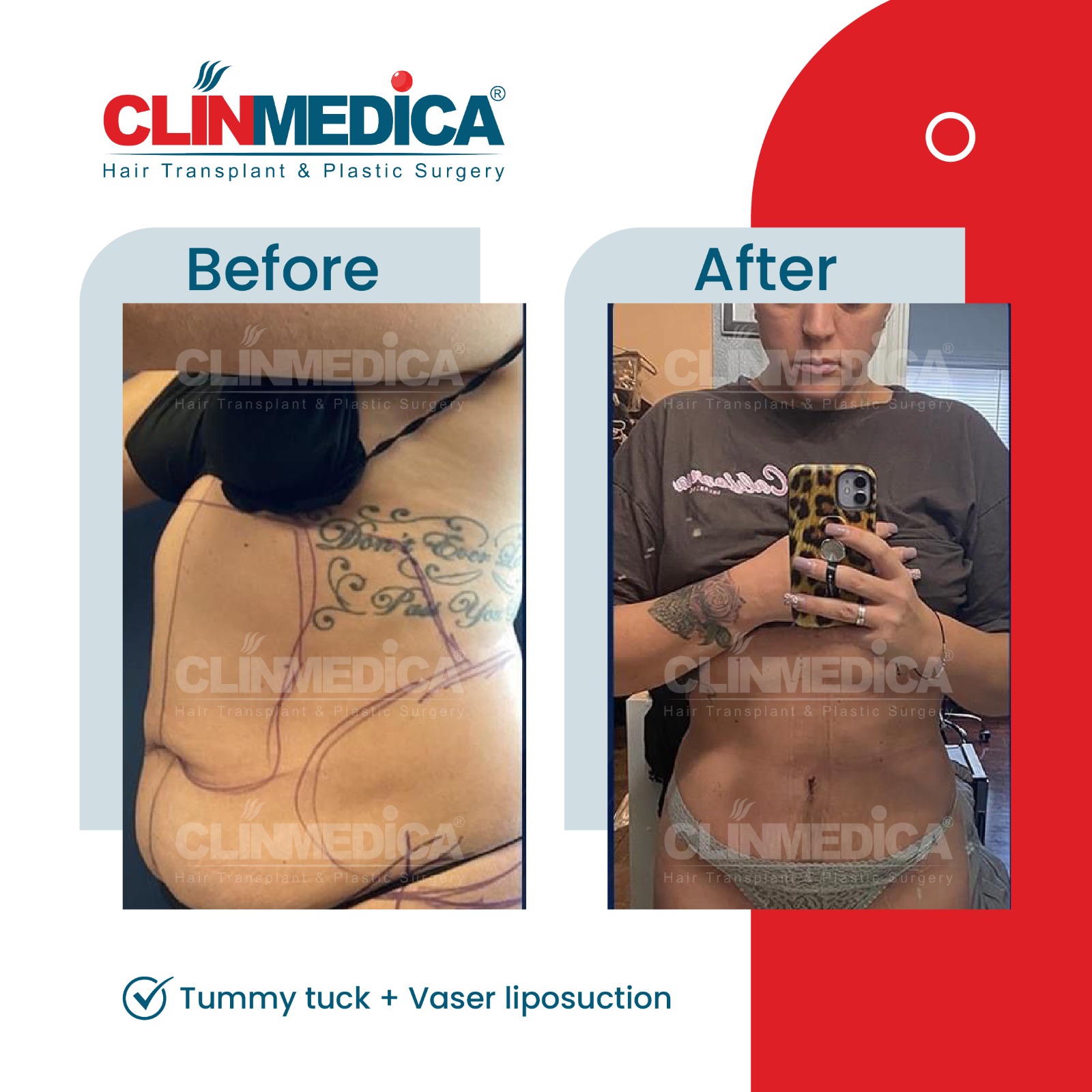 Mommy Makeover in Turkey before and after - ClinMedica