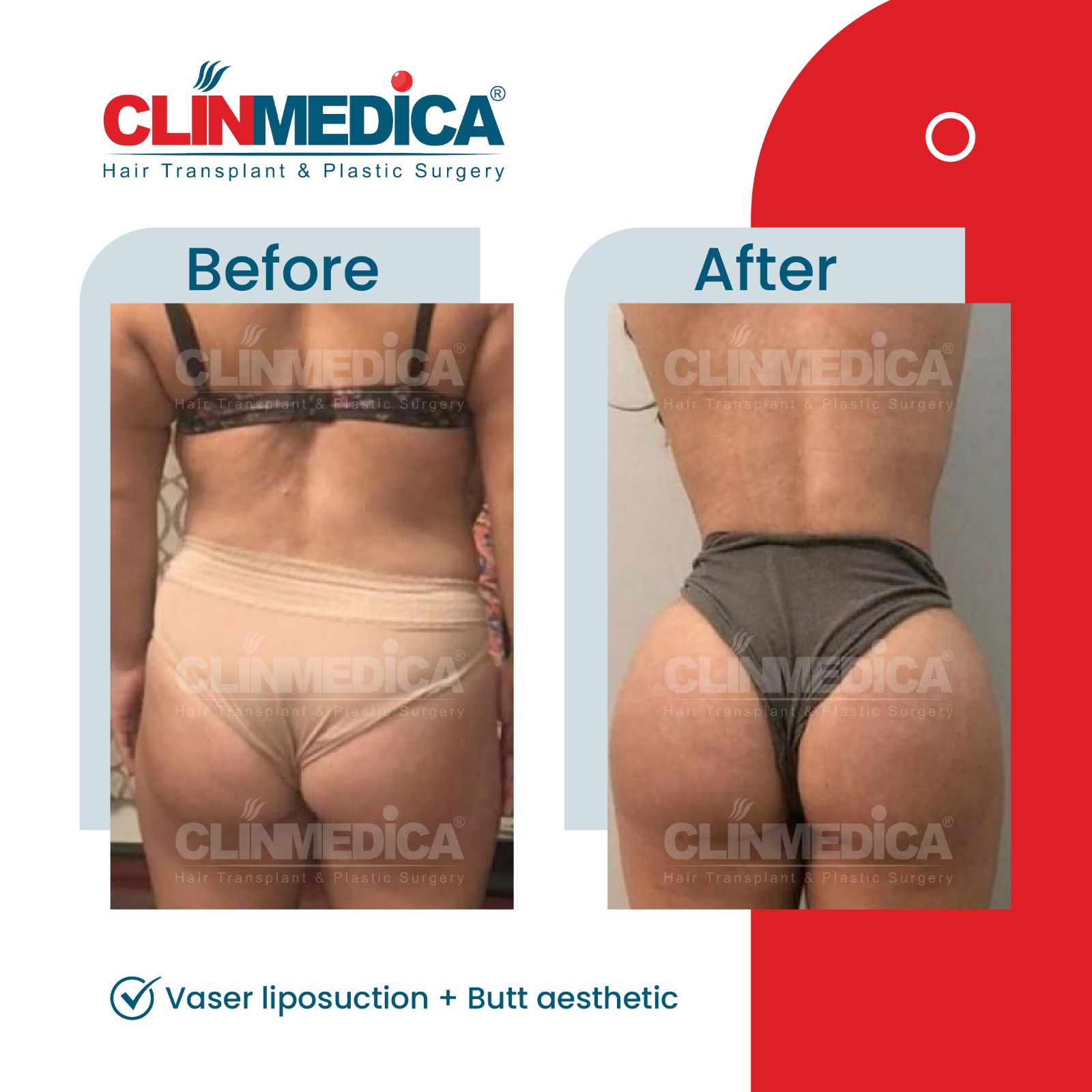 Tummy Tuck in Turkey before and after - ClinMedica