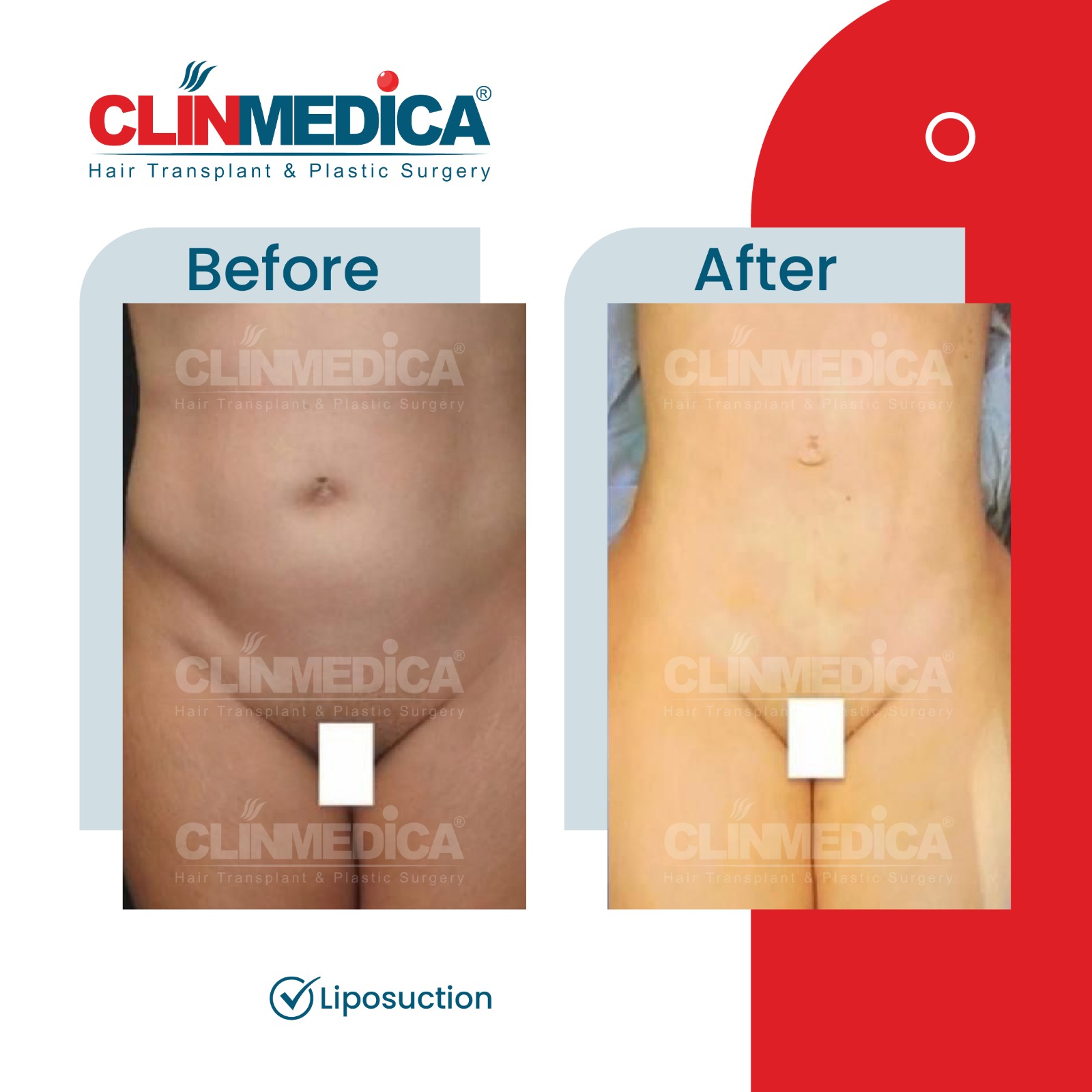 Liposuction in Turkey before and after - ClinMedica