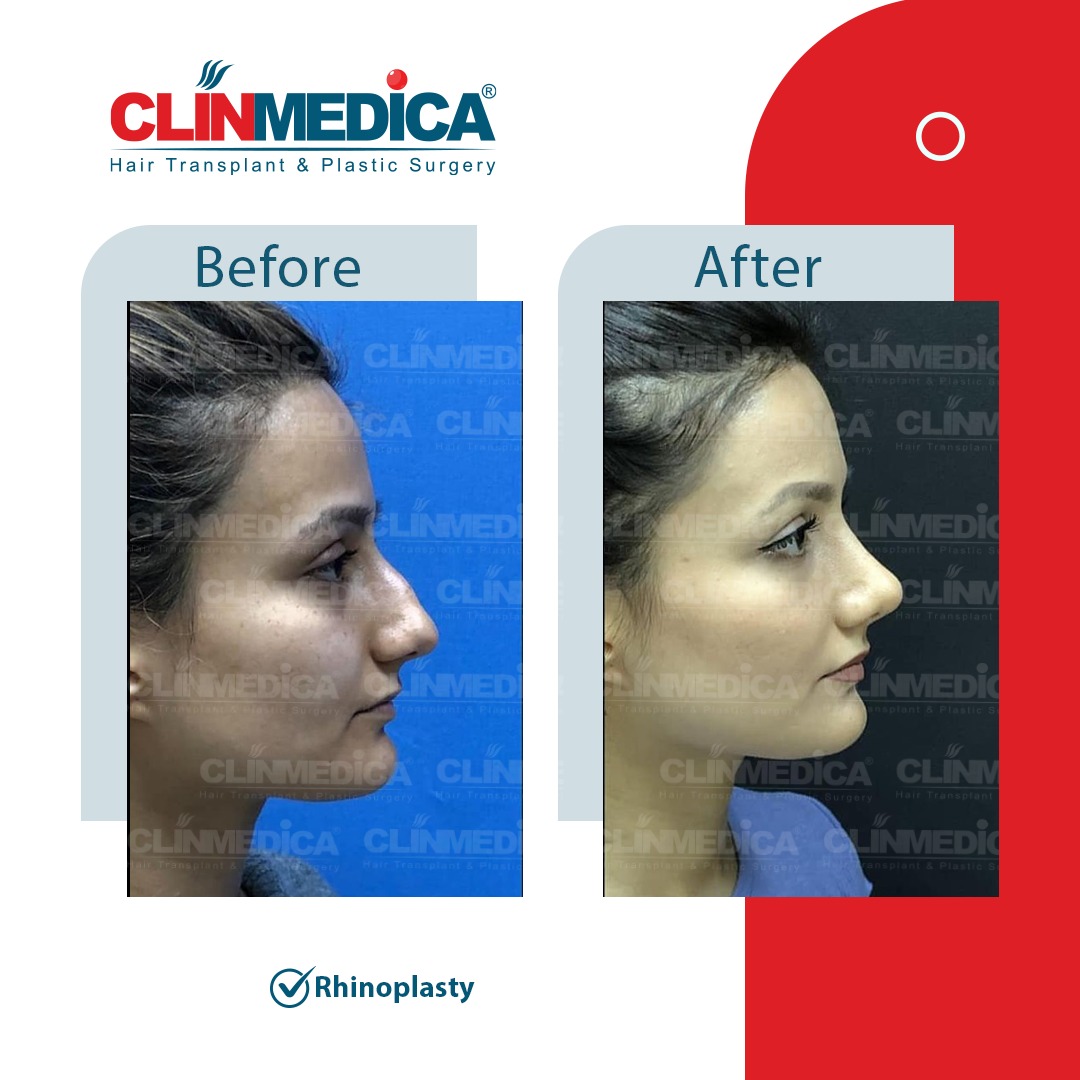 Rhinoplasty in Turkey before and after - ClinMedica