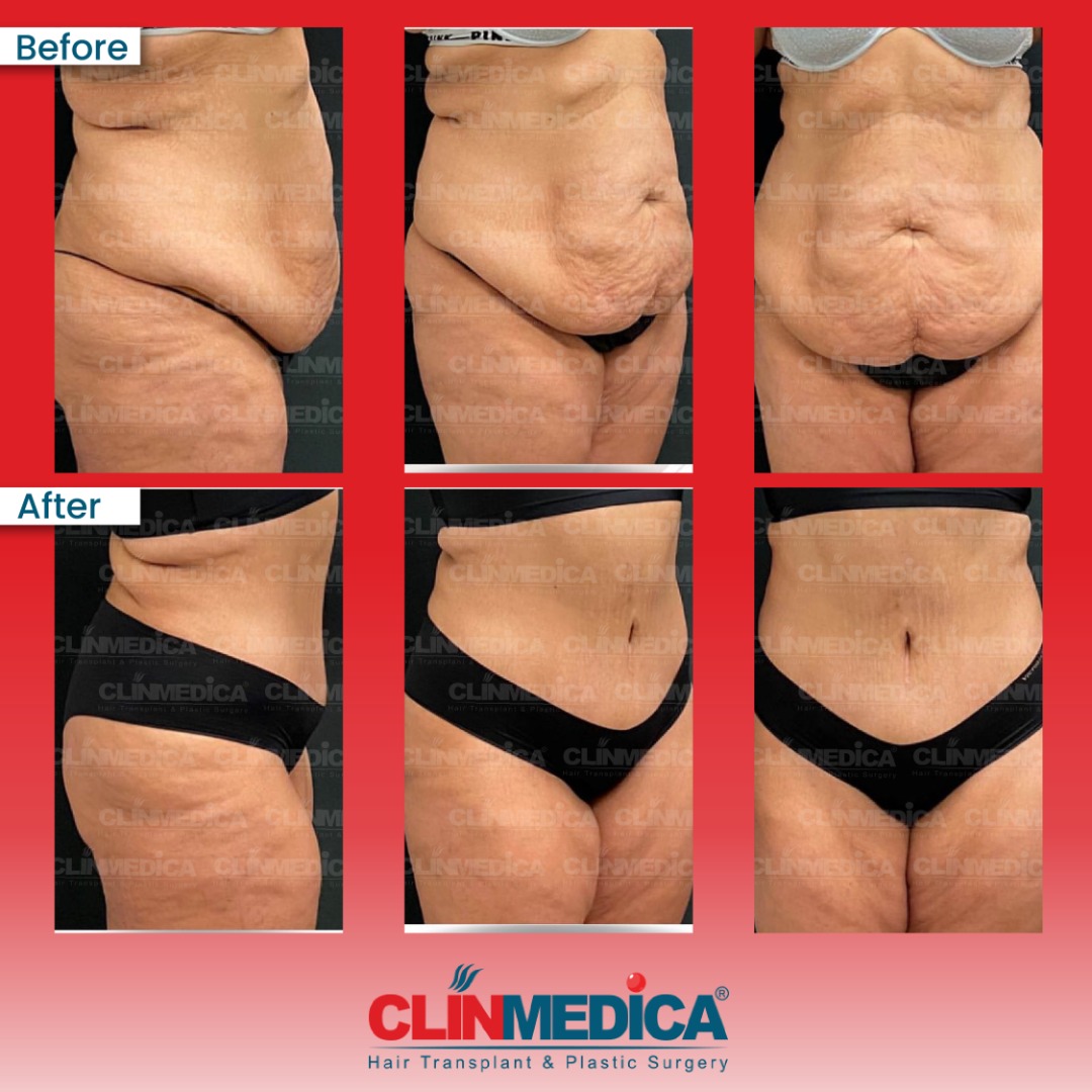plastic surgery in Turkey before and after - ClinMedica