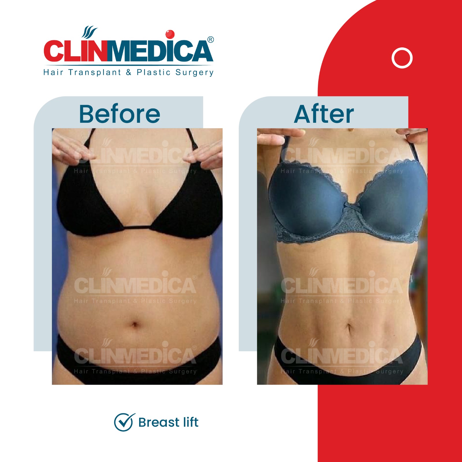 Breast Lift in Turkey before and after - ClinMedica