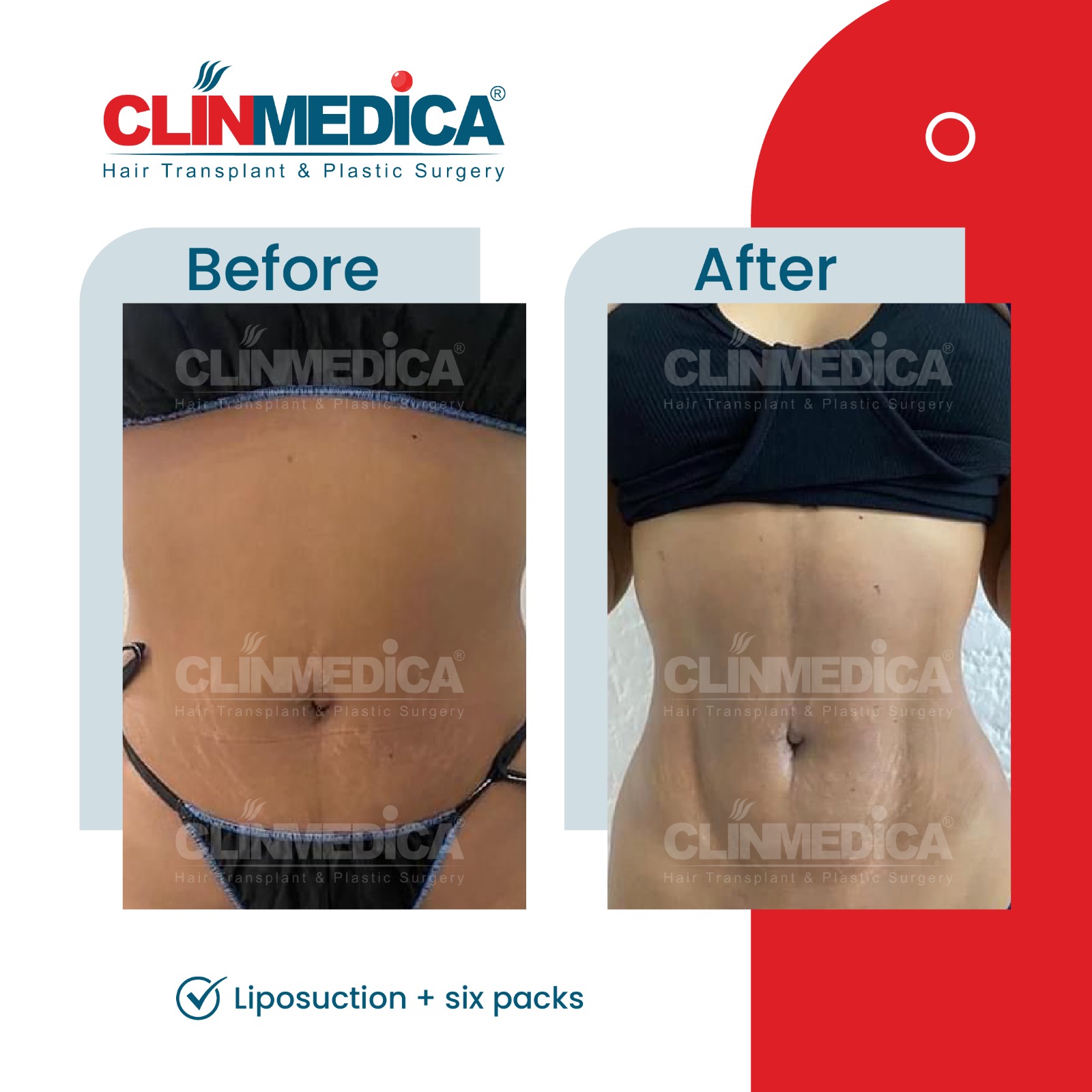 Liposuction and six packin Turkey before and after - ClinMedica